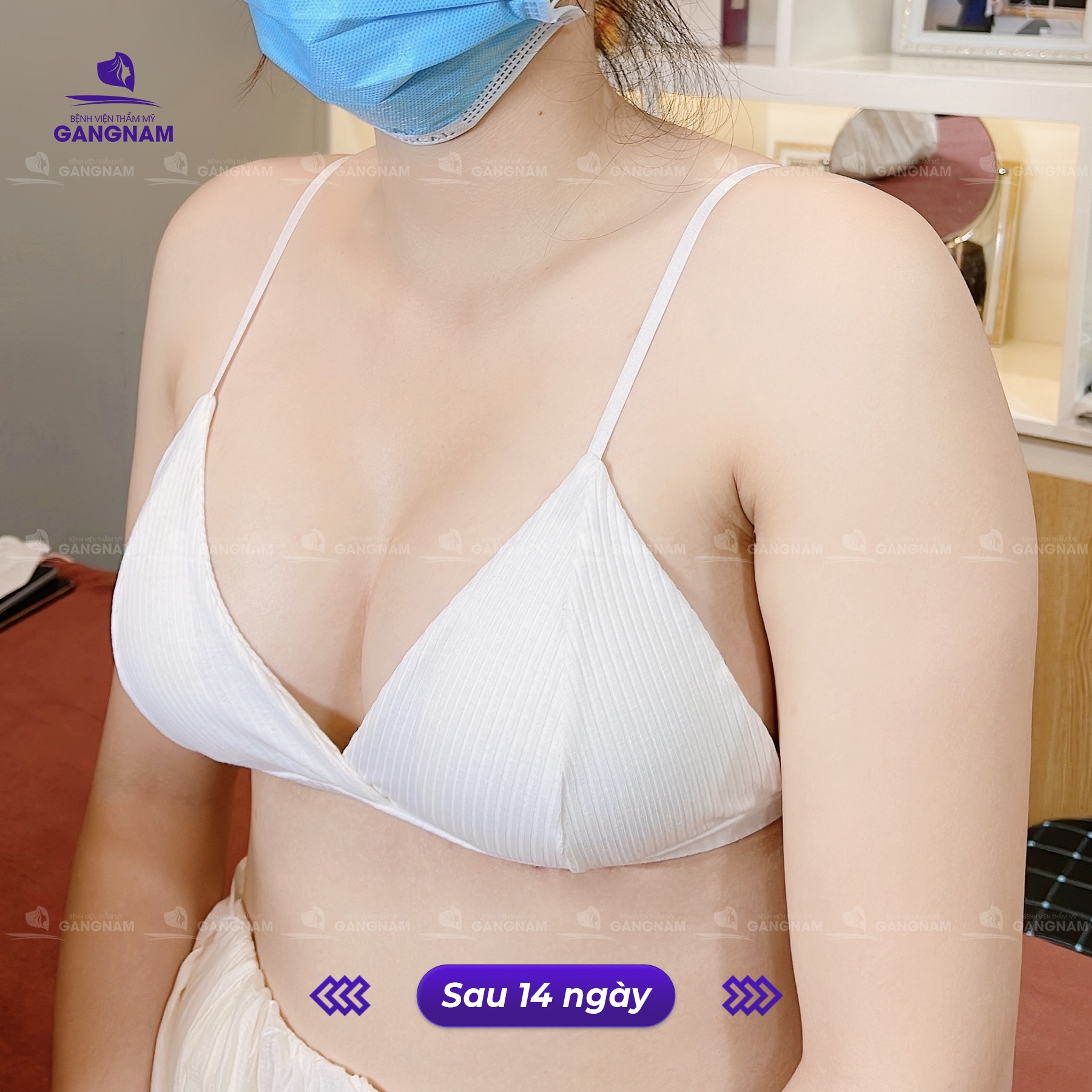 Nâng ngực túi silicon ergonomic – Giải pháp hoàn hảo cho vòng 1 tự nhiên 4 Tại sao nâng ngực túi silicon ergonomic lại được ưa chuộng đến vậy?