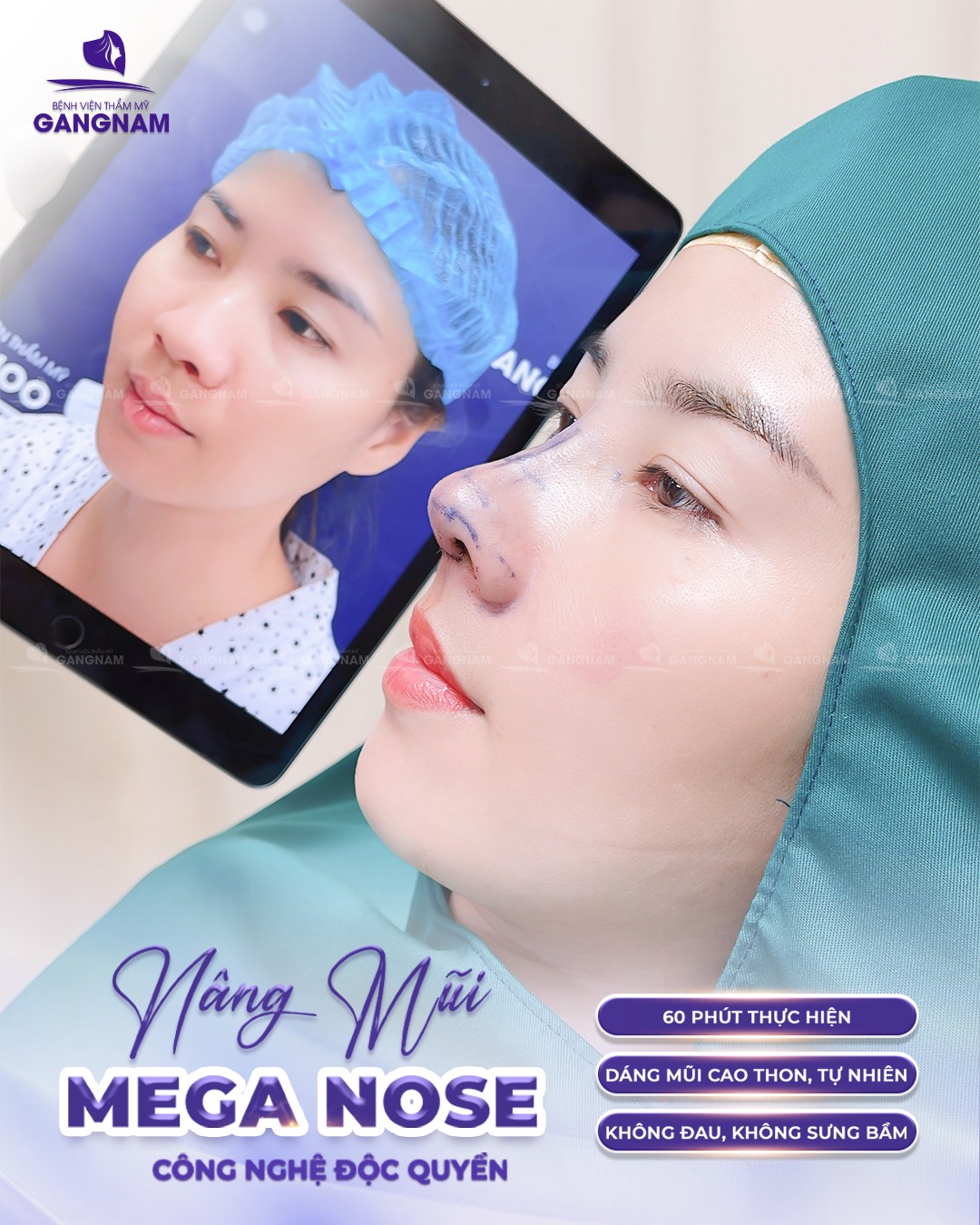Nâng mũi cấu trúc Mega Nose: Giải pháp thẩm mỹ mũi tiên tiến 6 Nâng mũi cấu trúc Mega Nose tại Thẩm mỹ Gangnam