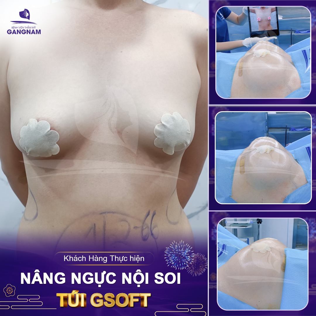 Nâng vòng 1 túi GSoft: Giải pháp cho vòng 1 tự nhiên, mềm mại như thật 5 Đối tượng nào nên chọn nâng vòng 1 túi GSoft?