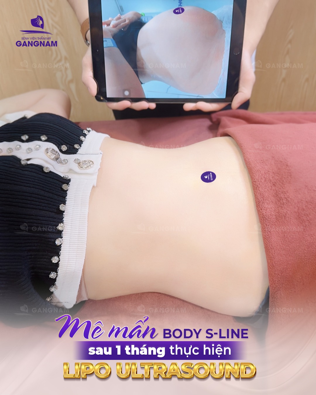 Hút mỡ bụng Lipo Ultrasound: Cơ chế hoạt động, ưu điểm và quy trình chuẩn y khoa 4 Hút mỡ bụng lipo Ultrasound là gì và cơ chế hoạt động
