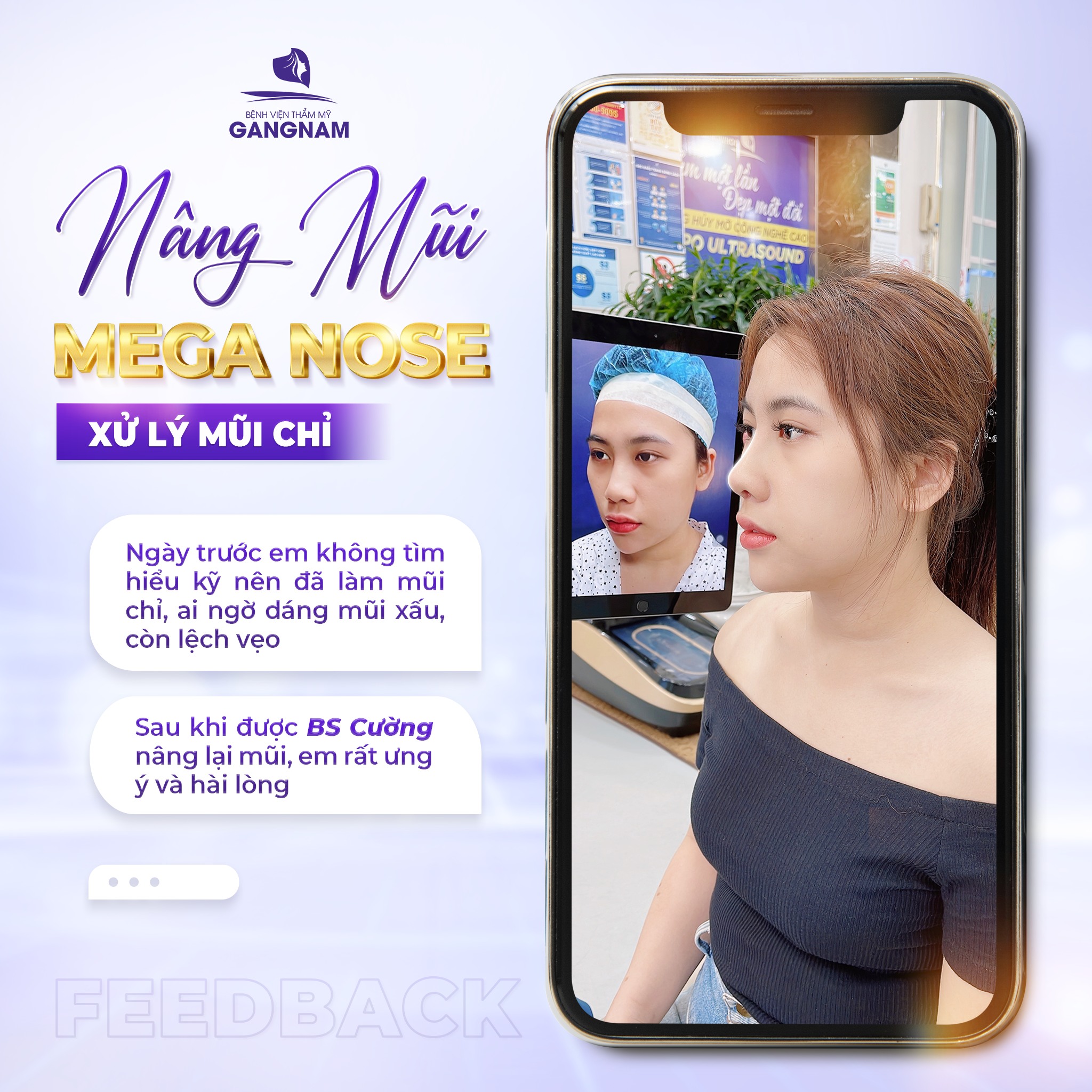 Nâng mũi cấu trúc Mega Nose: Giải pháp thẩm mỹ mũi tiên tiến 4 Tại sao chọn nâng mũi cấu trúc Mega Nose?