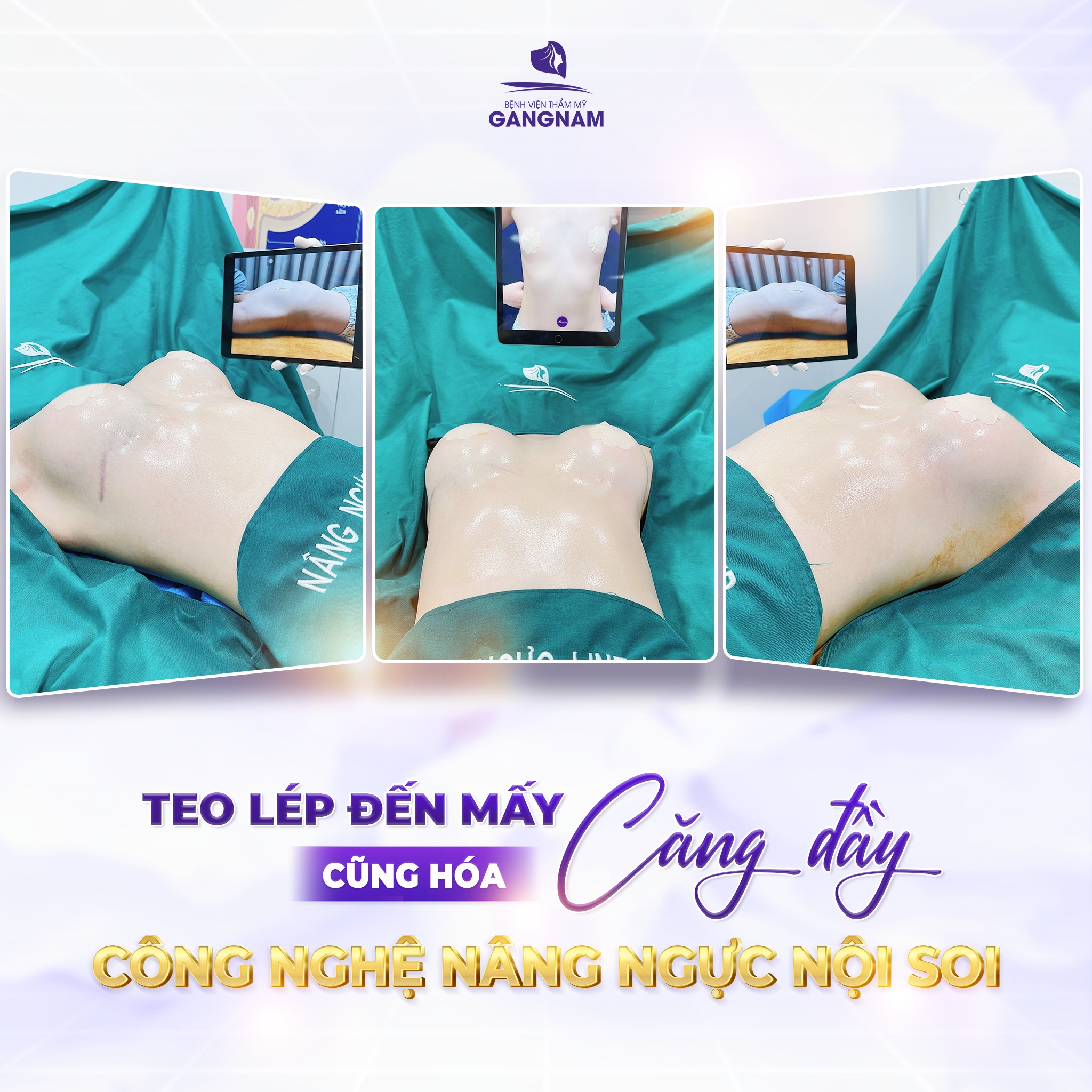 Nâng ngực túi độn mềm mại – Xu hướng làm đẹp tự nhiên 5 Nâng ngực túi độn mềm mại – Xu hướng làm đẹp tự nhiên 2