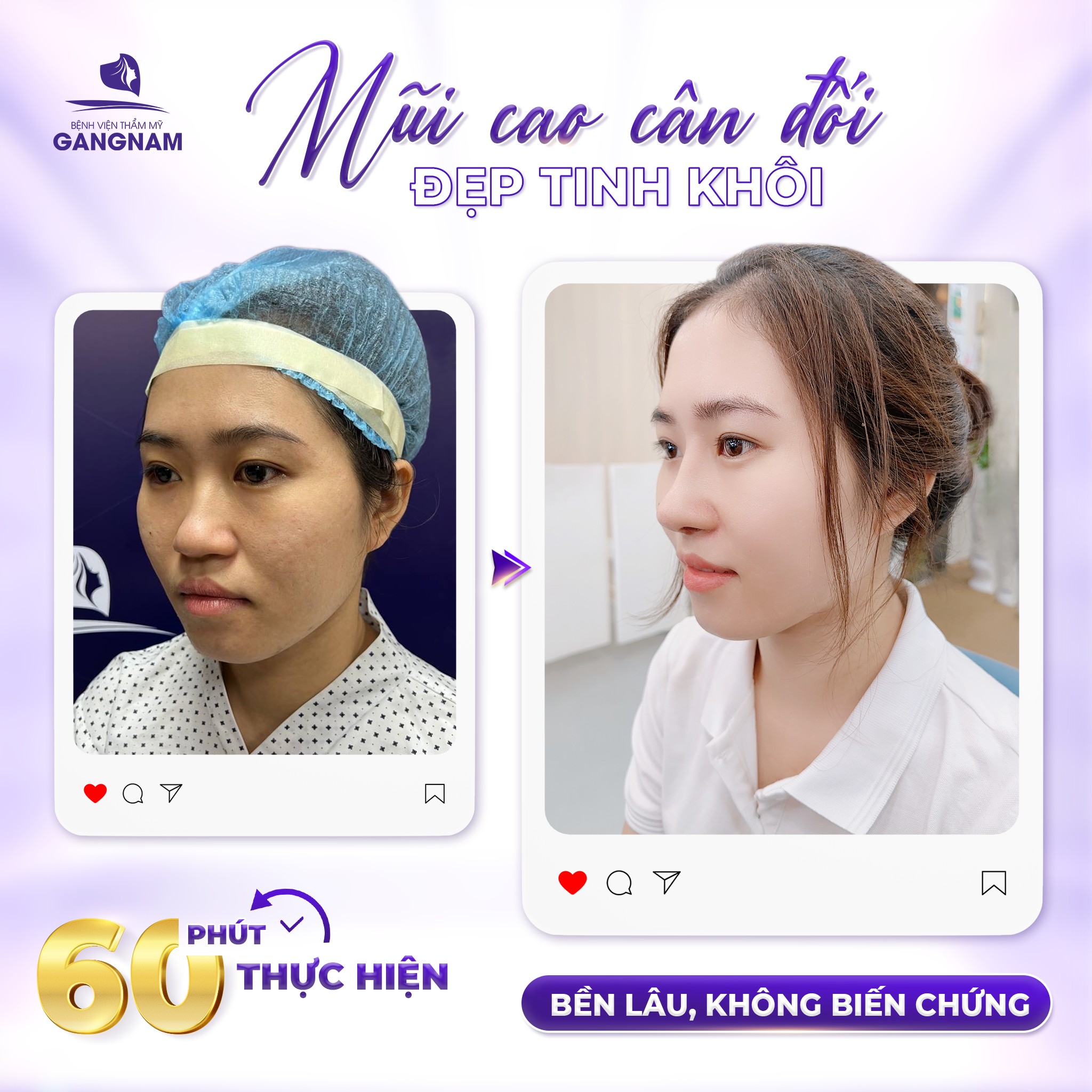 Nâng mũi cấu trúc chuẩn y khoa – Giải pháp tái tạo dáng mũi hoàn hảo 5 Nâng mũi cấu trúc chuẩn y khoa – Giải pháp tái tạo dáng mũi hoàn hảo 2