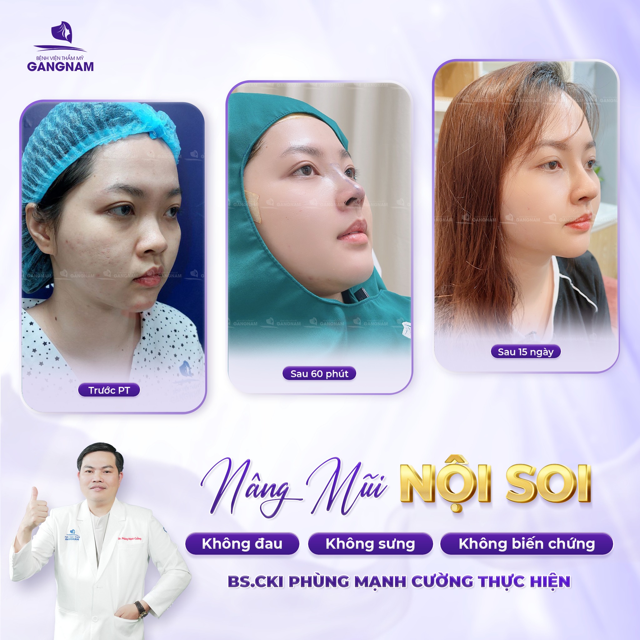 Nâng mũi cấu trúc nội soi: Phương pháp thẩm mỹ mũi tiên tiến 5 Đối tượng phù hợp với nâng mũi cấu trúc nội soi