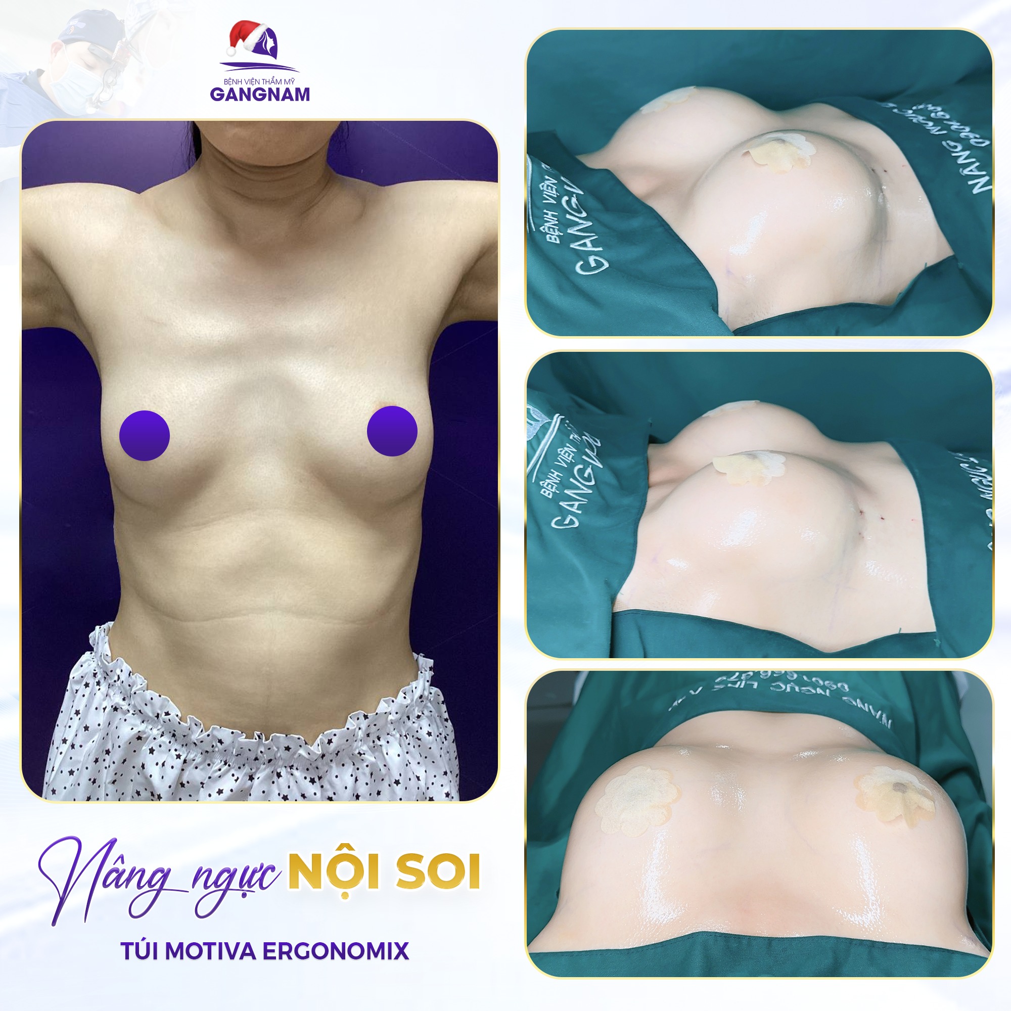 Nâng ngực 4K nội soi: Công nghệ hiện đại cho vòng 1 hoàn hảo và an toàn 4 Nâng ngực 4K nội soi là gì và tại sao nó vượt trội?