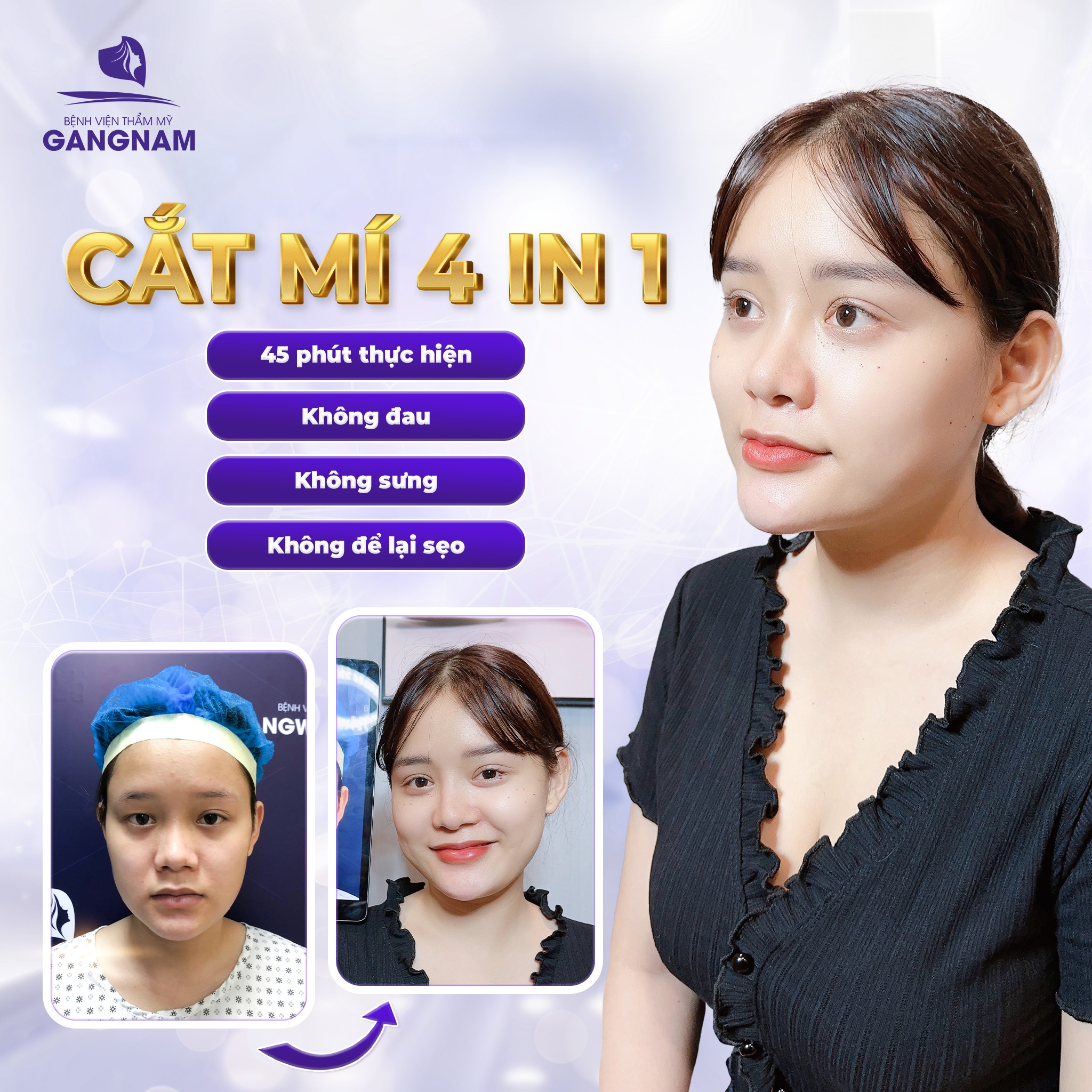 Cắt mí 4in1 thẩm mỹ – Giải pháp toàn diện cho đôi mắt hoàn hảo tự nhiên 4 Cắt mí 4in1 thẩm mỹ bao gồm những kỹ thuật nào?