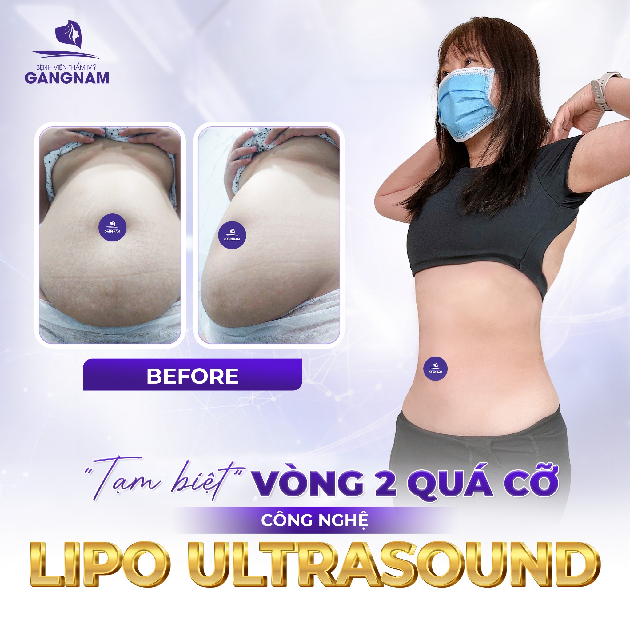 Hút mỡ bụng công nghệ Lipo – Giải pháp lấy lại vòng eo thon gọn 6 Hút mỡ bụng công nghệ Lipo hiện đại tại Thẩm mỹ Gangnam