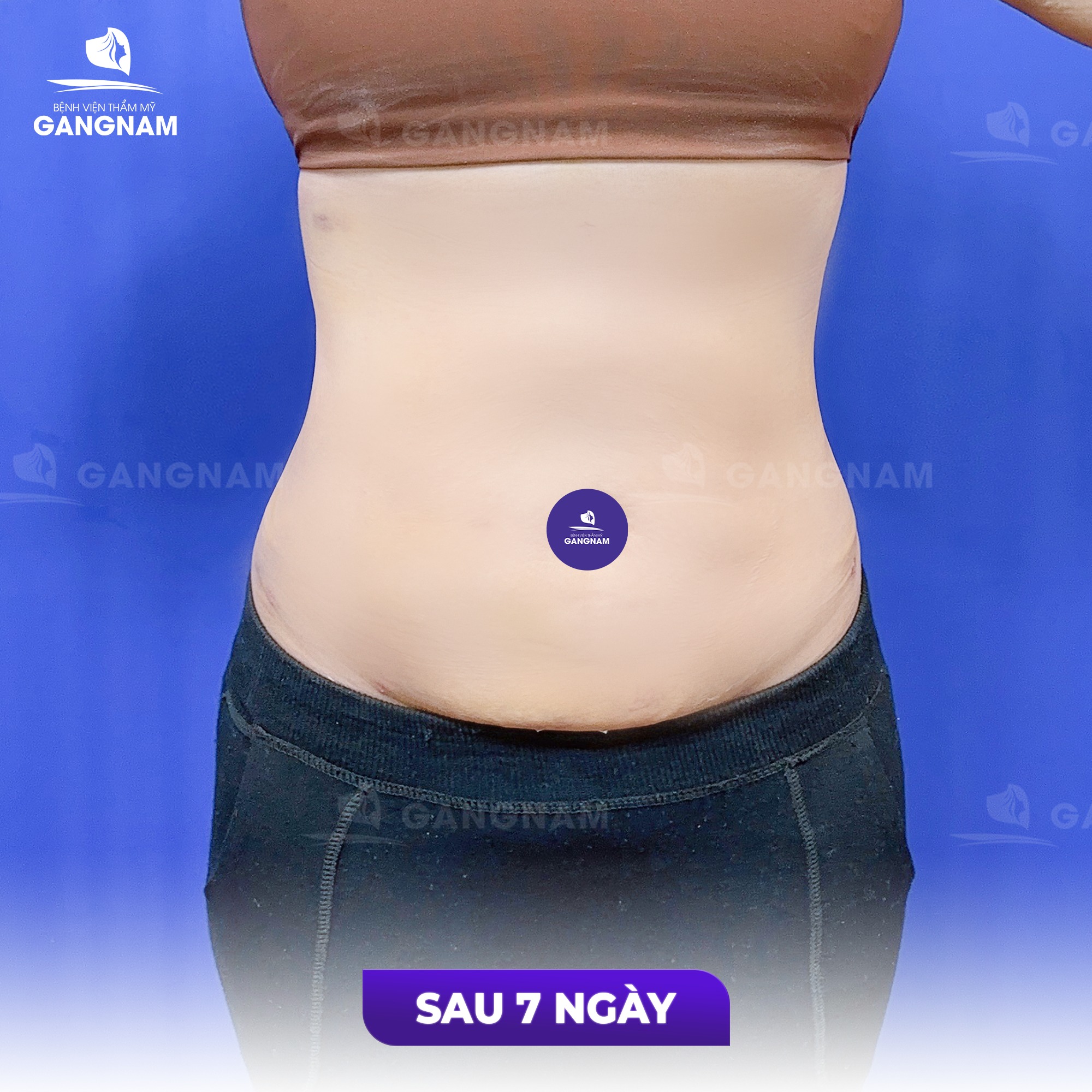 Hút mỡ bụng công nghệ Lipo – Giải pháp lấy lại vòng eo thon gọn 4 Các dòng công nghệ Lipo dẫn đầu xu hướng