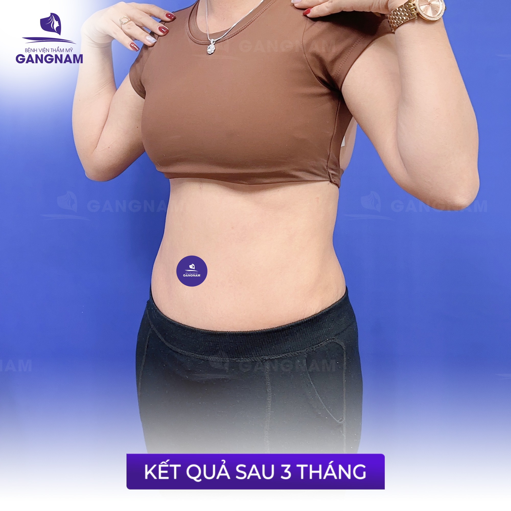 Hút mỡ bụng toàn phần: Giải pháp hiệu quả cho vòng eo thon gọn 5 Quy trình thực hiện hút mỡ bụng toàn phần an toàn