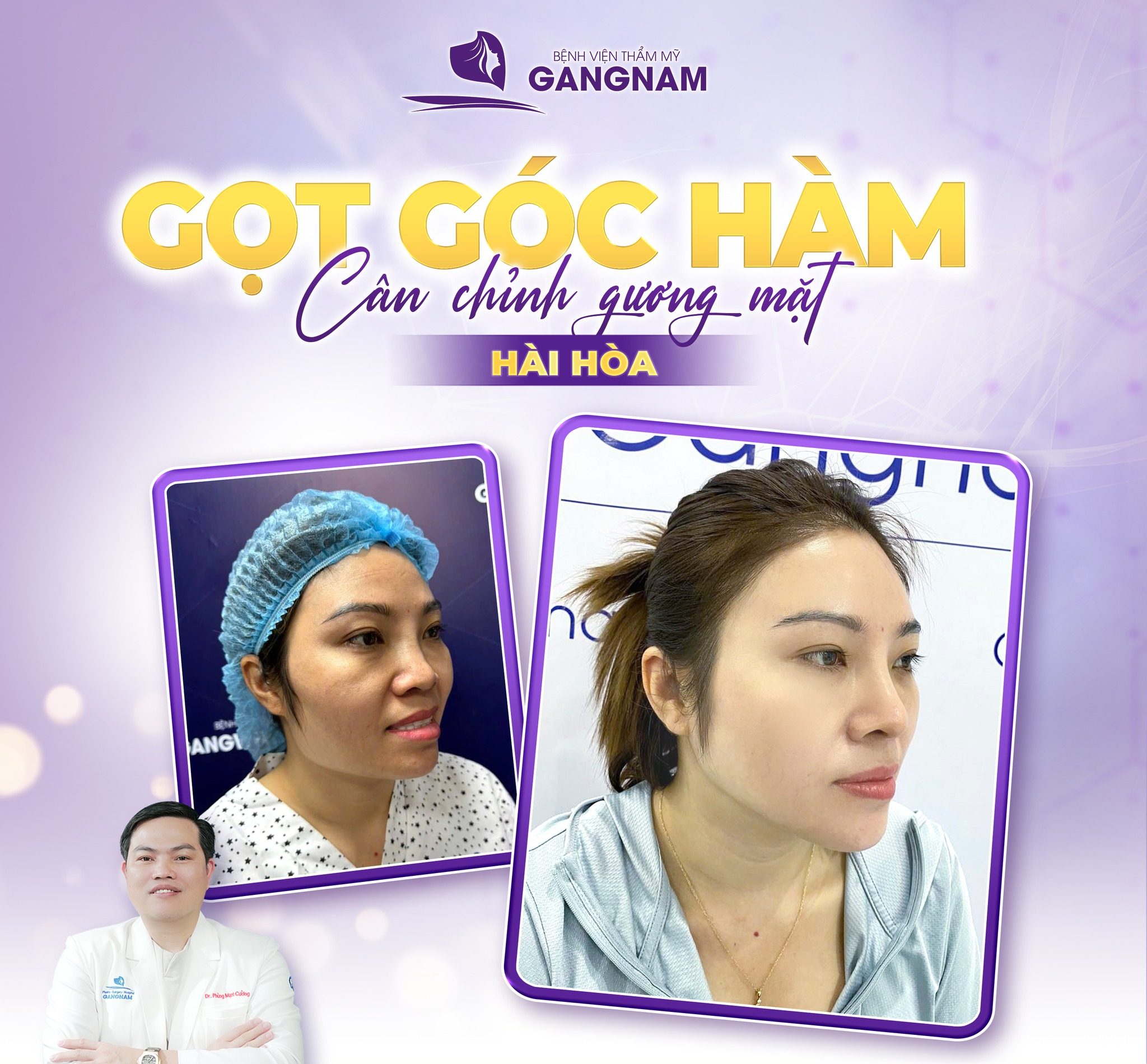 Gọt hàm nội soi: Phương pháp thẩm mỹ hiện đại cho khuôn mặt V-line 4 Gọt hàm nội soi là gì và cơ chế hoạt động