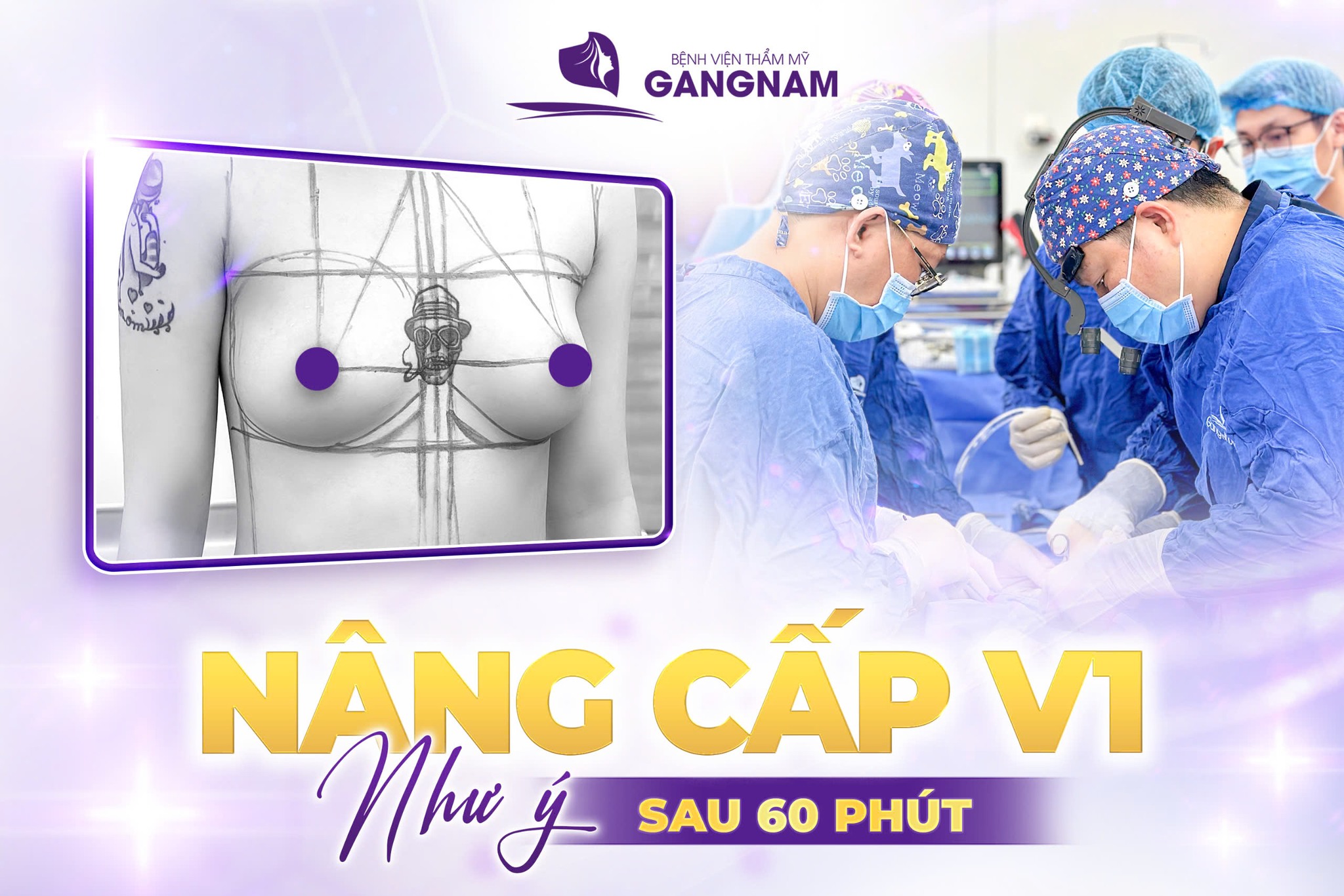 Nâng ngực túi độn mềm mại – Xu hướng làm đẹp tự nhiên 6 Nâng ngực túi độn mềm mại chuẩn y khoa tại Thẩm mỹ Gangnam