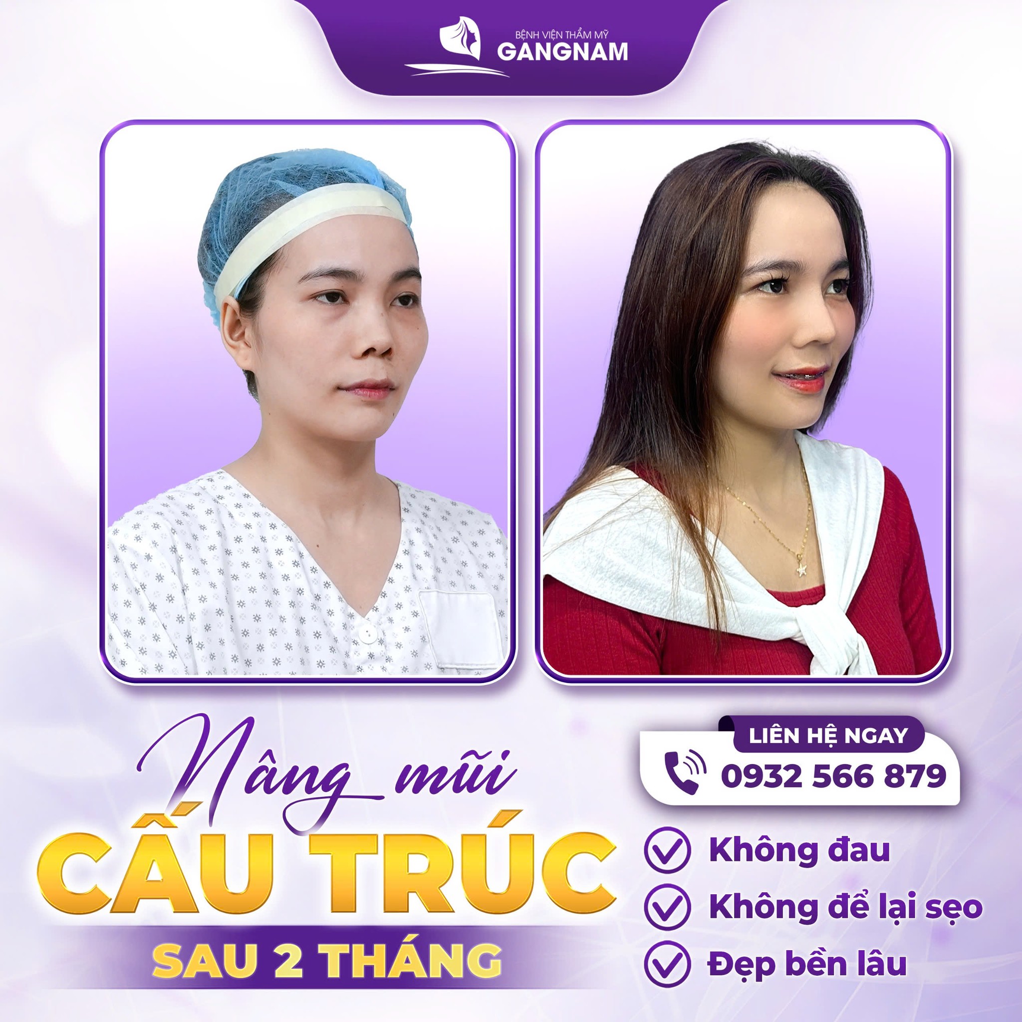 Nâng mũi cấu trúc nội soi: Phương pháp thẩm mỹ mũi tiên tiến 6 Thẩm mỹ Gangnam – Nâng tầm nhan sắc chuẩn Hàn Quốc