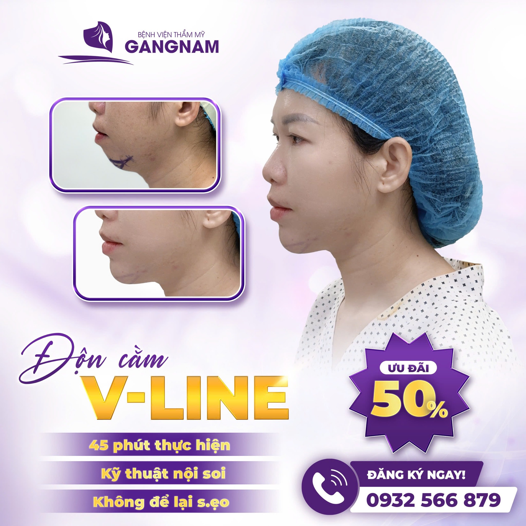 Độn cằm nội soi V-line – Giải pháp hoàn hảo cho gương mặt thanh tú 5 Quy trình thực hiện độn cằm nội soi V-line chi tiết