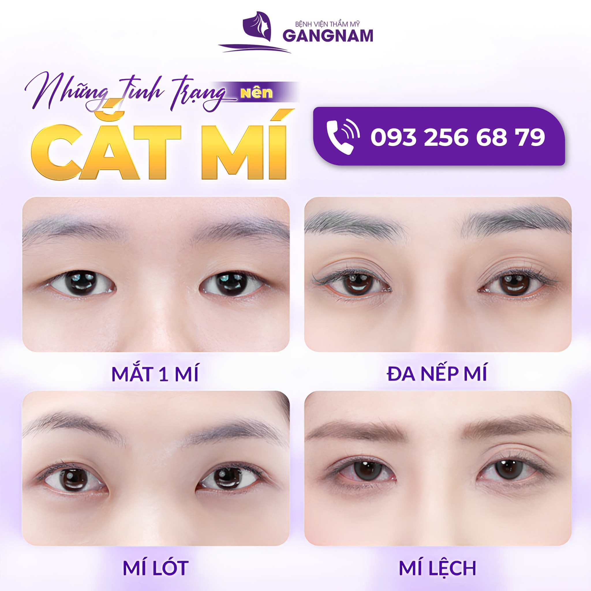 Cắt mí thẩm mỹ – Giải pháp sở hữu đôi mắt hai mí tự nhiên, an toàn và bền vững 5 Đối tượng nào nên thực hiện cắt mí thẩm mỹ?