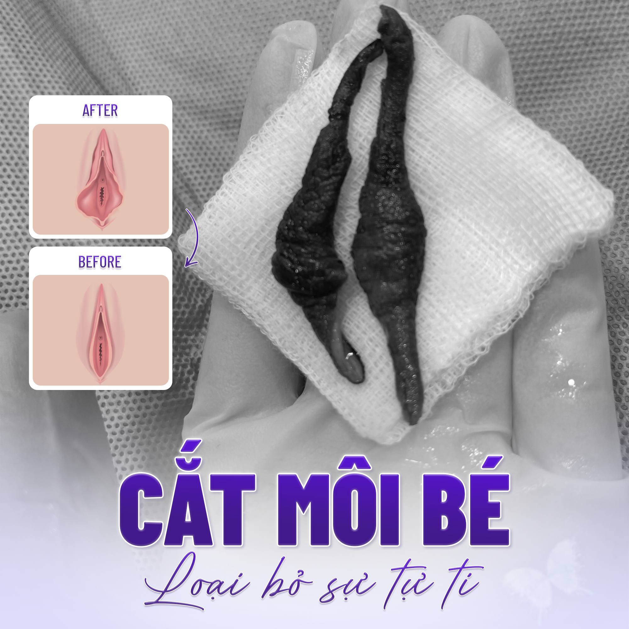 Cắt môi bé chuẩn y khoa – Giải pháp an toàn, thẩm mỹ cao cho vùng kín 4 Thế nào là cắt môi bé chuẩn y khoa?