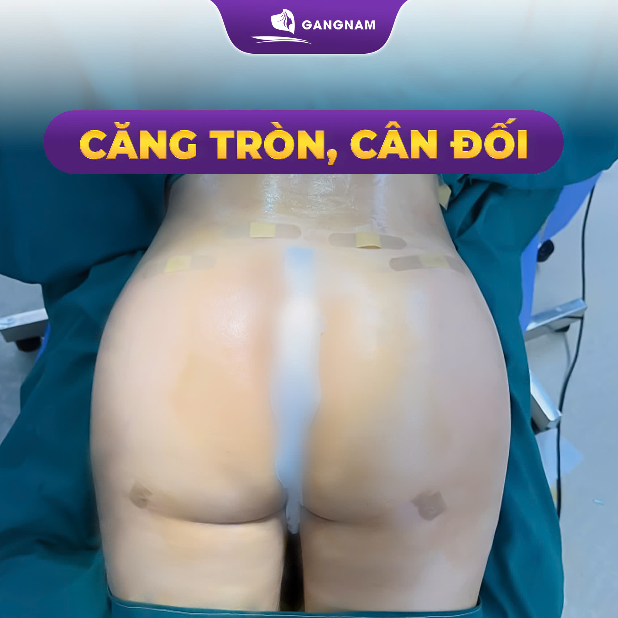 Cấy mỡ mông – Bí quyết sở hữu vòng 3 căng tròn tự nhiên 4 Cấy mỡ mông là gì và tại sao nên chọn phương pháp này?