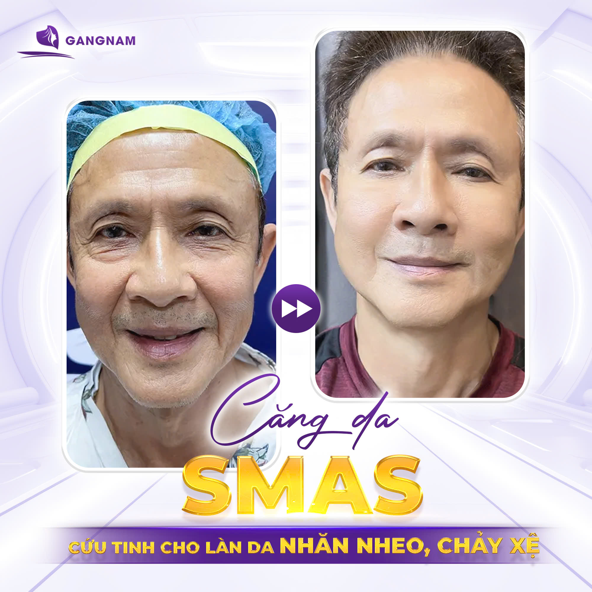 Căng da mặt nội soi SMAS: Giải pháp trẻ hóa toàn diện 4 Căng da mặt nội soi SMAS là gì?