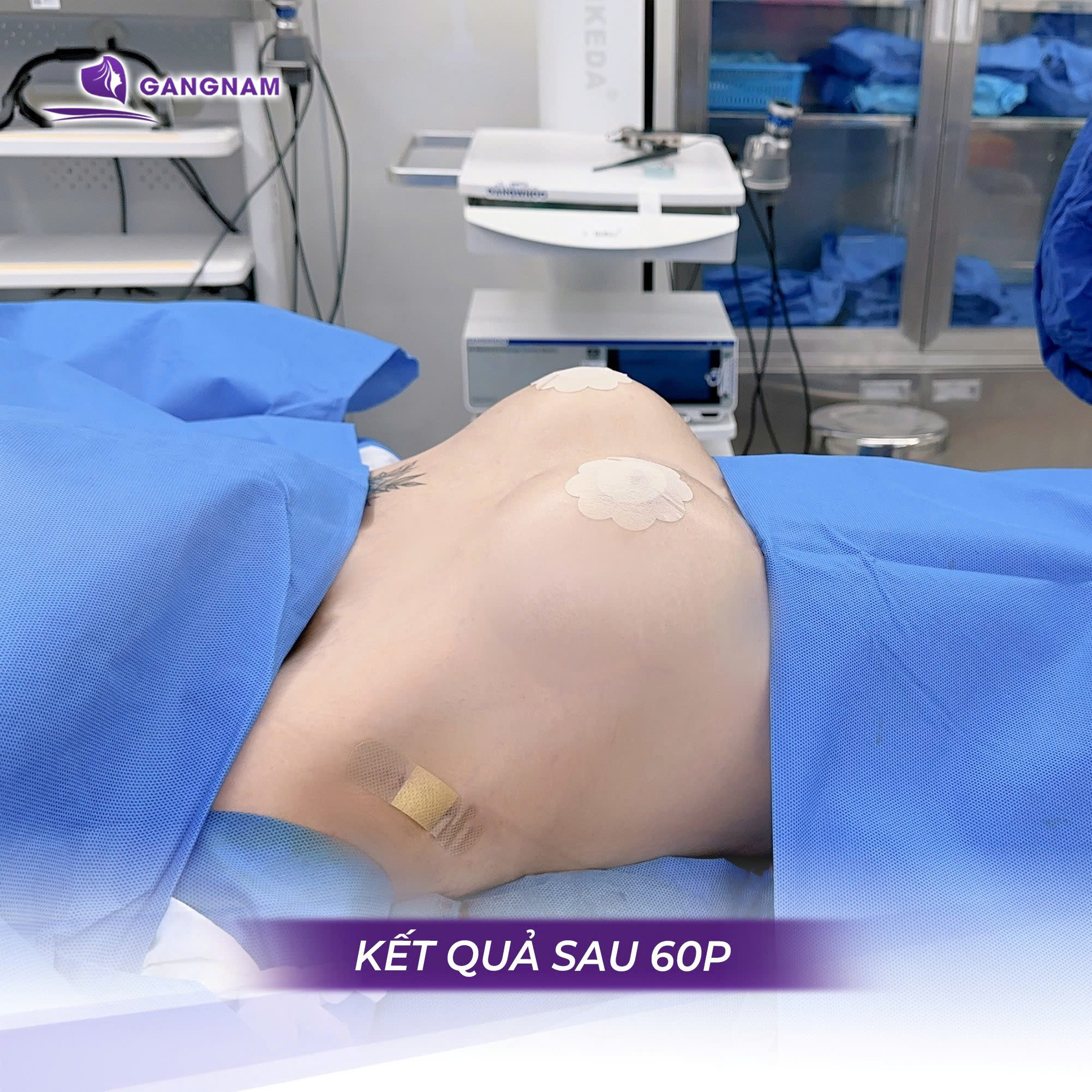 Nâng ngực túi độn silicon: Phương pháp thẩm mỹ vòng 1 an toàn và hiện đại 4 Đặc điểm nổi bật của túi độn silicon thế hệ mới trong nâng ngực túi độn silicon