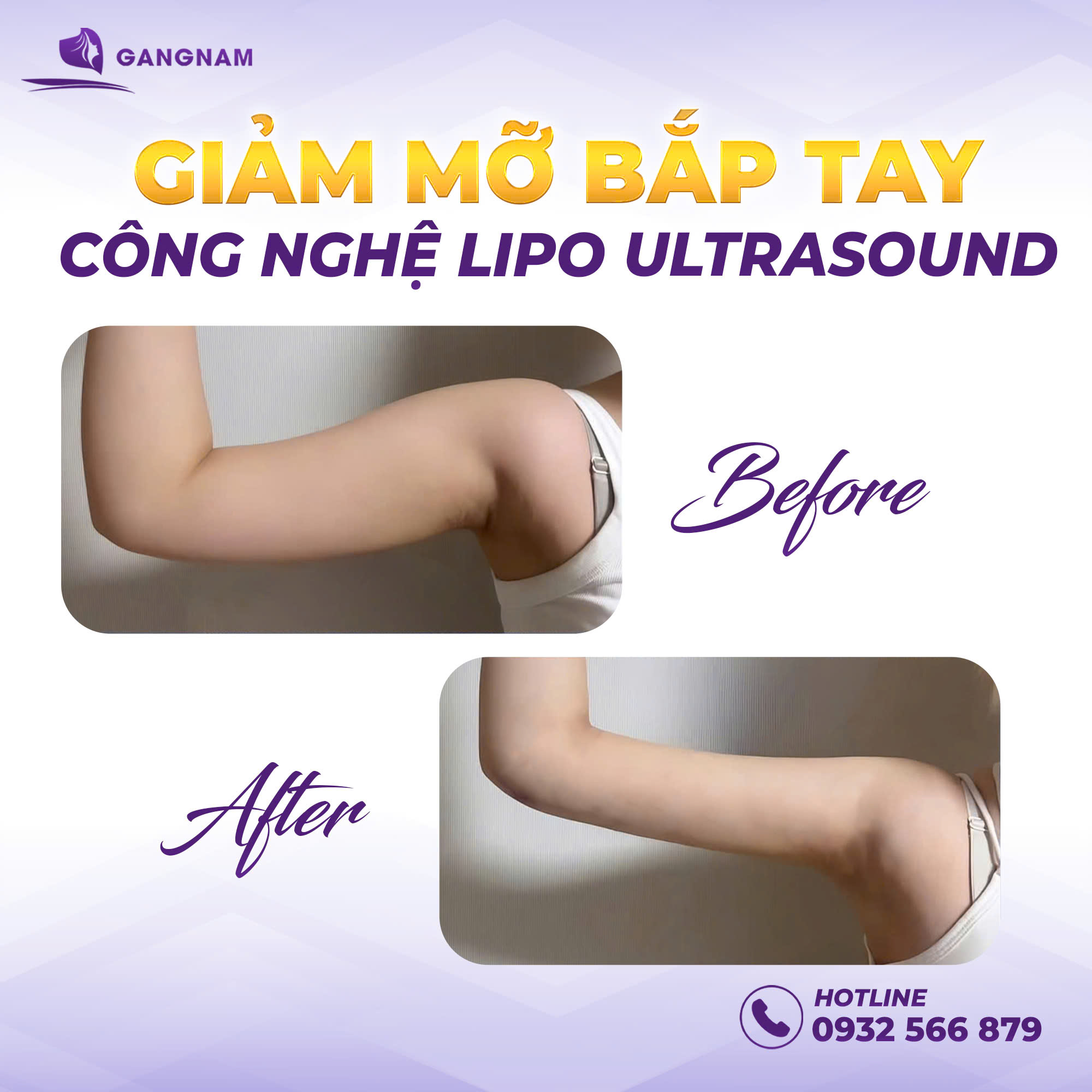 Hút mỡ cánh tay Lipo Ultrasound – Giải pháp thon gọn bắp tay an toàn 6 Thẩm mỹ Gangnam – Địa chỉ hút mỡ cánh tay Lipo Ultrasound uy tín
