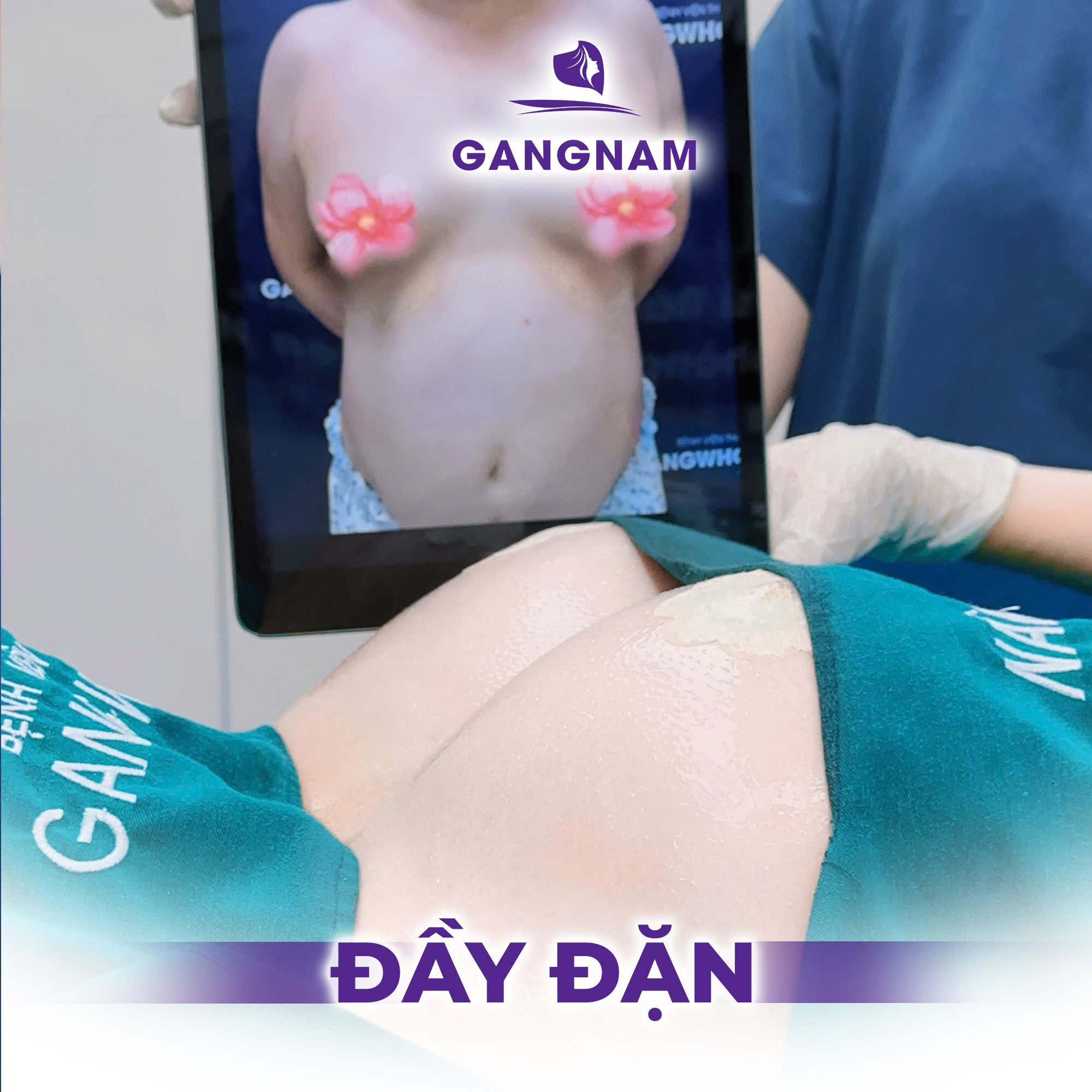 Nâng vòng 1 túi GSoft: Giải pháp cho vòng 1 tự nhiên, mềm mại như thật 4 Túi GSoft là gì và tại sao lại đặc biệt trong nâng vòng 1 túi GSoft?