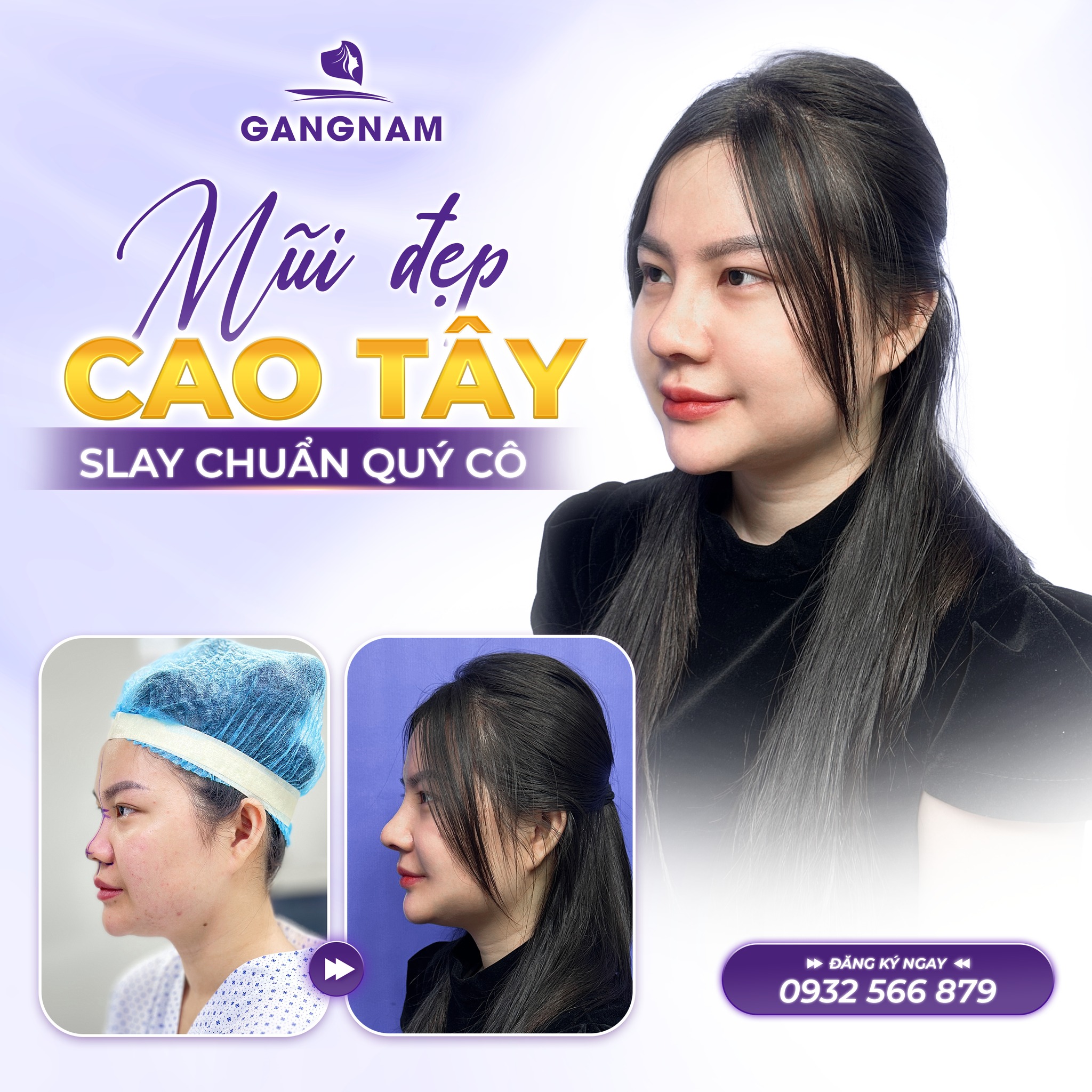 Nâng mũi bọc sụn: Phương pháp thẩm mỹ mũi an toàn và tự nhiên nhất 5 Các loại sụn bọc phổ biến trong nâng mũi bọc sụn