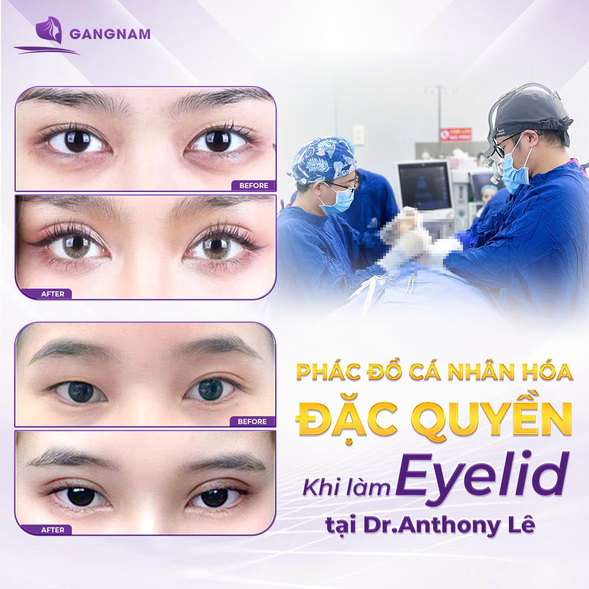 Cắt mí Eyelid không đau – Bí quyết sở hữu đôi mắt hai mí tự nhiên, êm ái 6 Cắt mí Eyelid không đau tại thẩm mỹ Gangnam