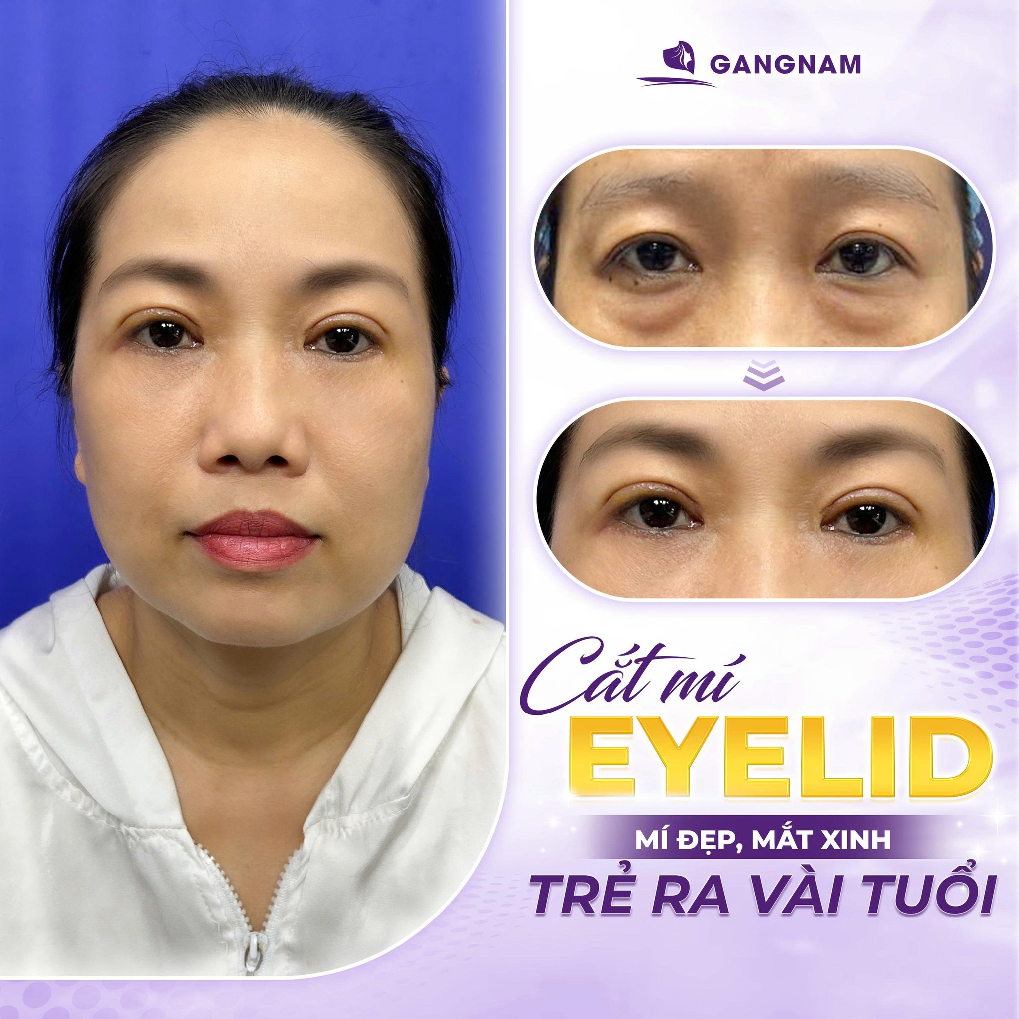 Cắt Mắt 2 Mí:Lộ Trình Hồi Phục Và Bí Quyết Tạo Nếp Mí Tự Nhiên An Toàn 4 Các kỹ thuật cắt mắt 2 mí phổ biến hiện nay