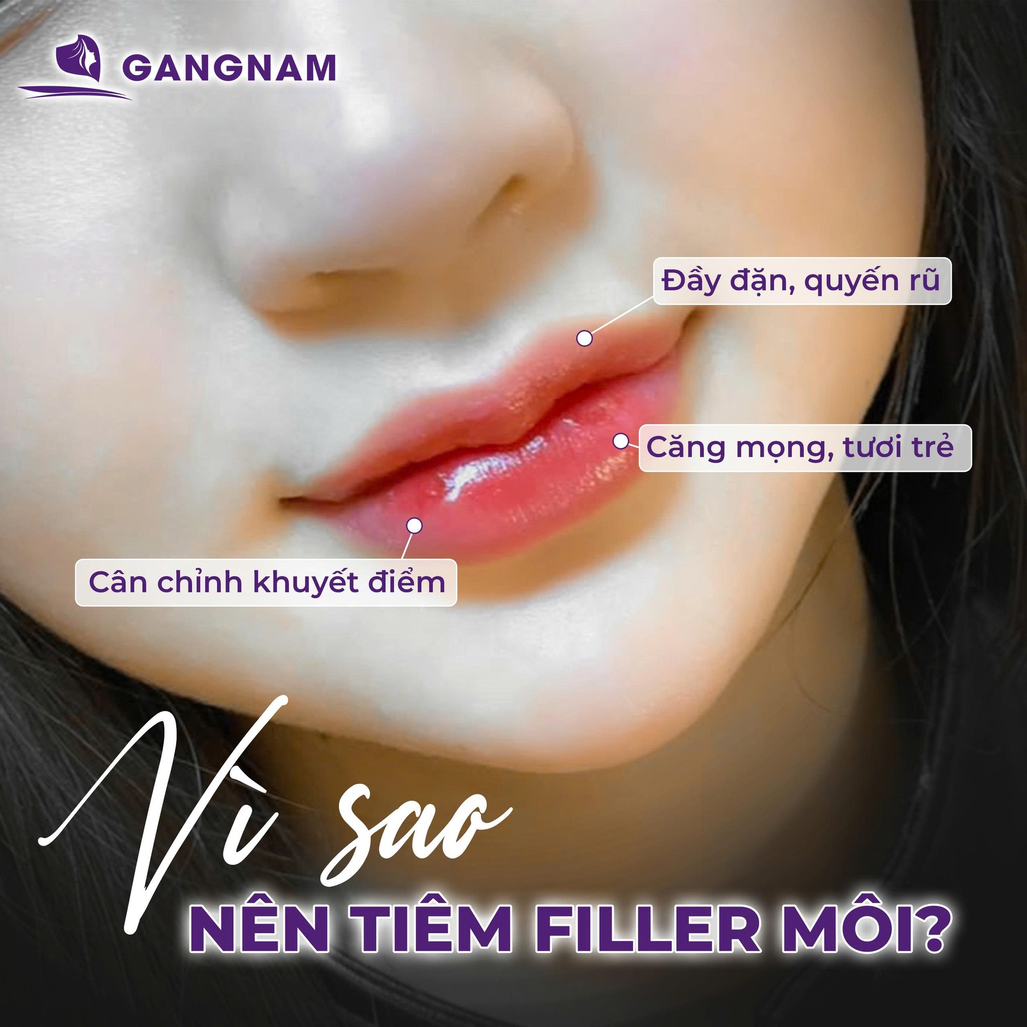 Tiêm filler môi căng bóng – Xu hướng làm đẹp tự nhiên 4 Tại sao tiêm filler môi căng bóng lại mang lại hiệu ứng hoàn hảo?