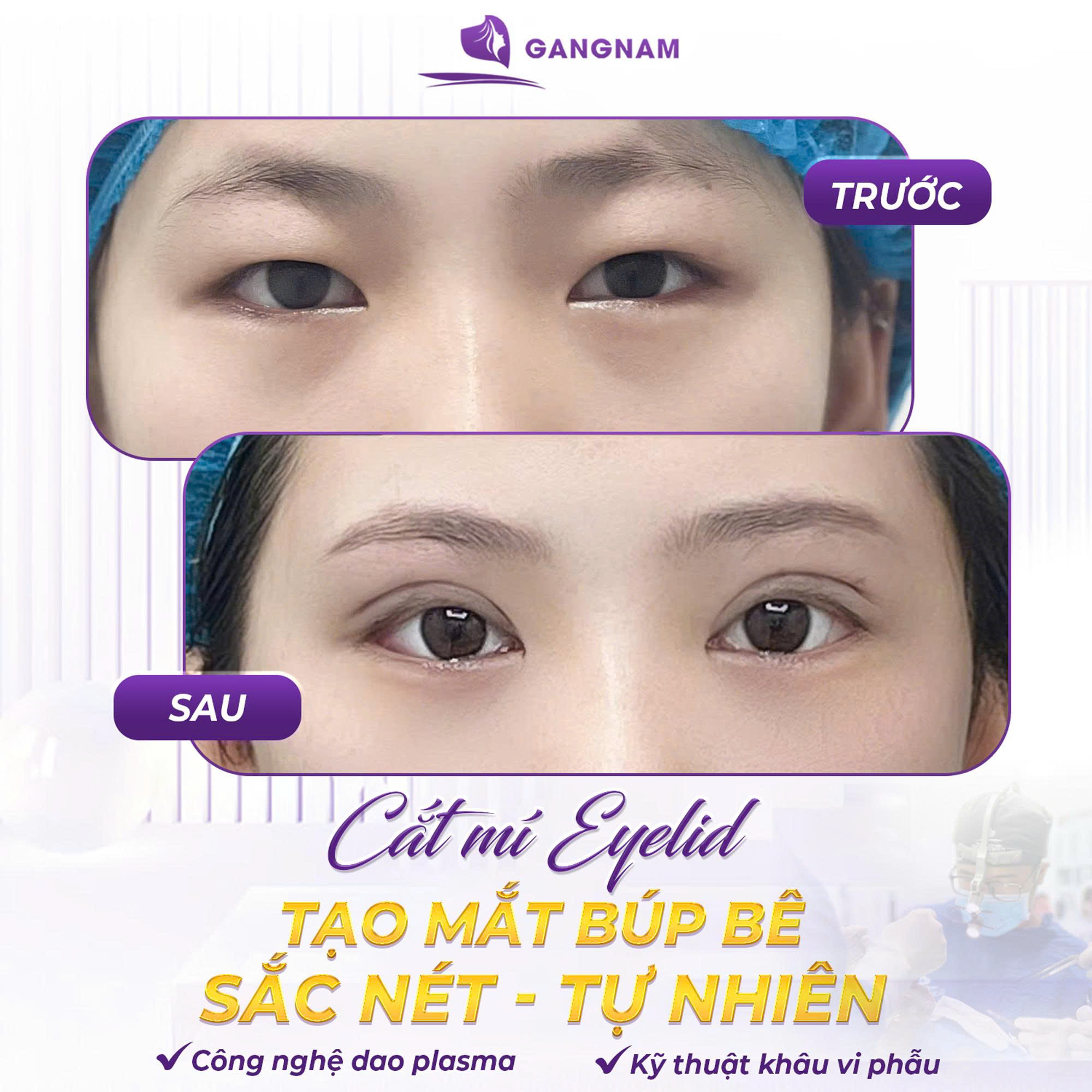 Cắt mí Eyelid định hình nếp mí: Bí quyết cho đôi mắt hai mí tự nhiên 6 Cắt mí Eyelid định hình nếp mí là gì và ưu điểm nổi bật
