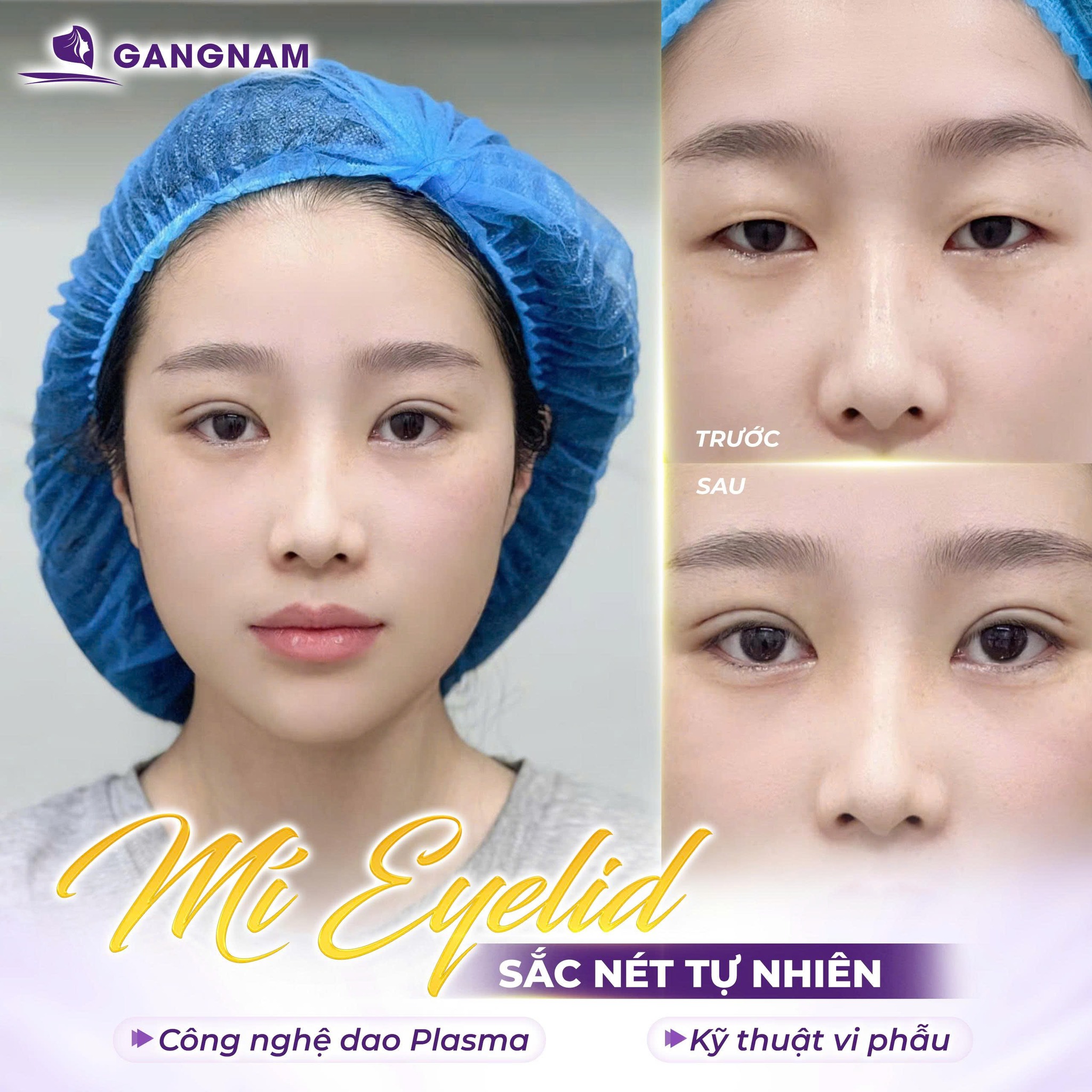 Cắt mắt Eyelid thẩm mỹ: Bí quyết sở hữu đôi mắt trẻ trung tự nhiên 5 Cắt mắt Eyelid thẩm mỹ: Bí quyết sở hữu đôi mắt trẻ trung tự nhiên 2