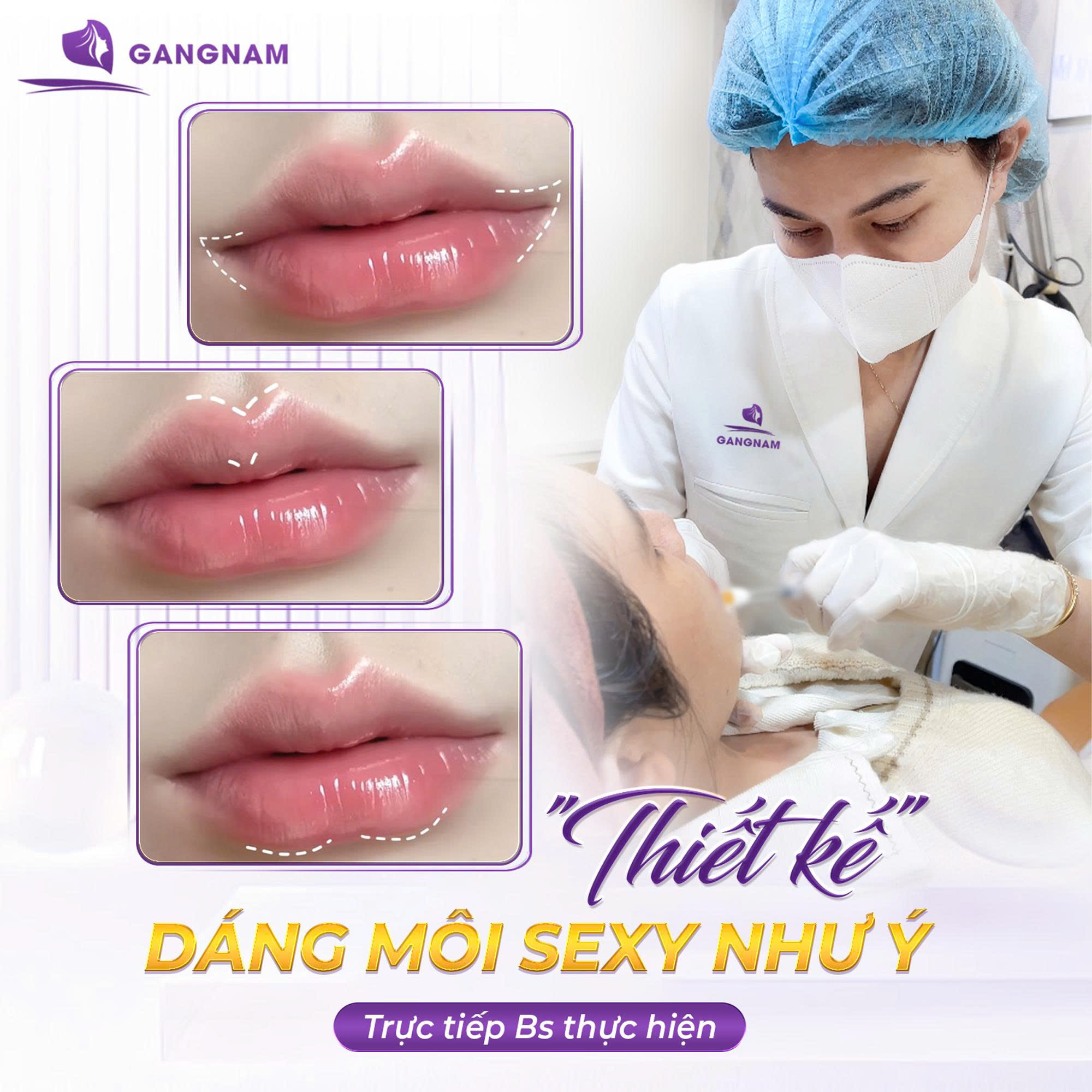 Tiêm filler môi căng bóng – Xu hướng làm đẹp tự nhiên 5 Kỹ thuật tiêm hiện đại giúp đạt hiệu ứng căng bóng tối đa
