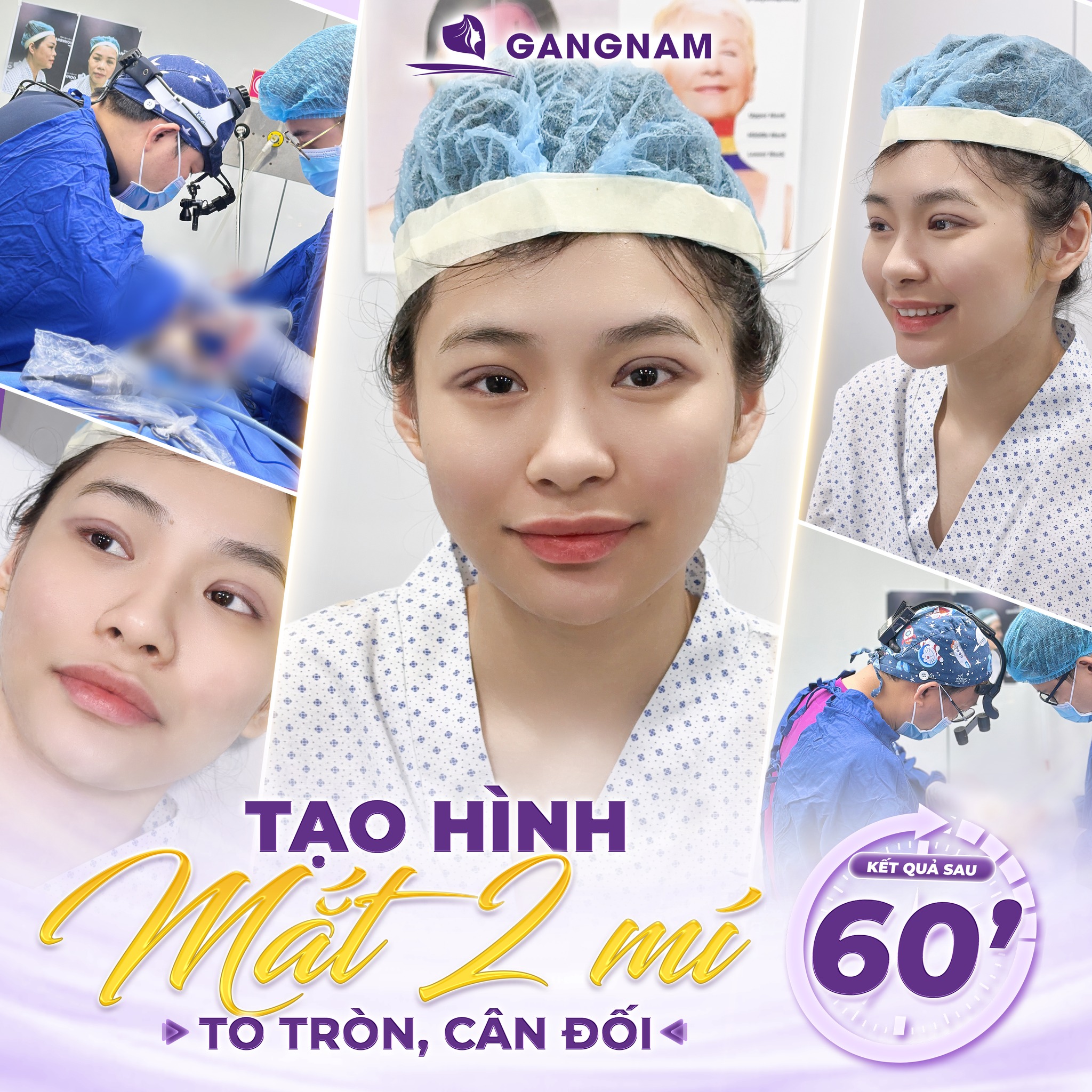 Tạo hình mắt 2 mí – Bí quyết sở hữu đôi mắt to tròn, tự nhiên và cuốn hút 4 Các phương pháp tạo hình mắt 2 mí phổ biến hiện nay