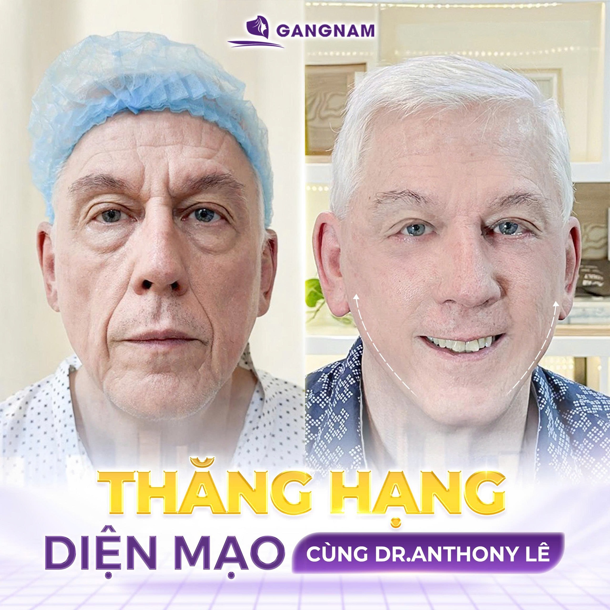 Căng Da Mặt SMAS Nội Soi: Giải Pháp Trẻ Hóa Toàn Diện, Hiệu Quả 5 Đối tượng phù hợp với căng da mặt SMAS nội soi