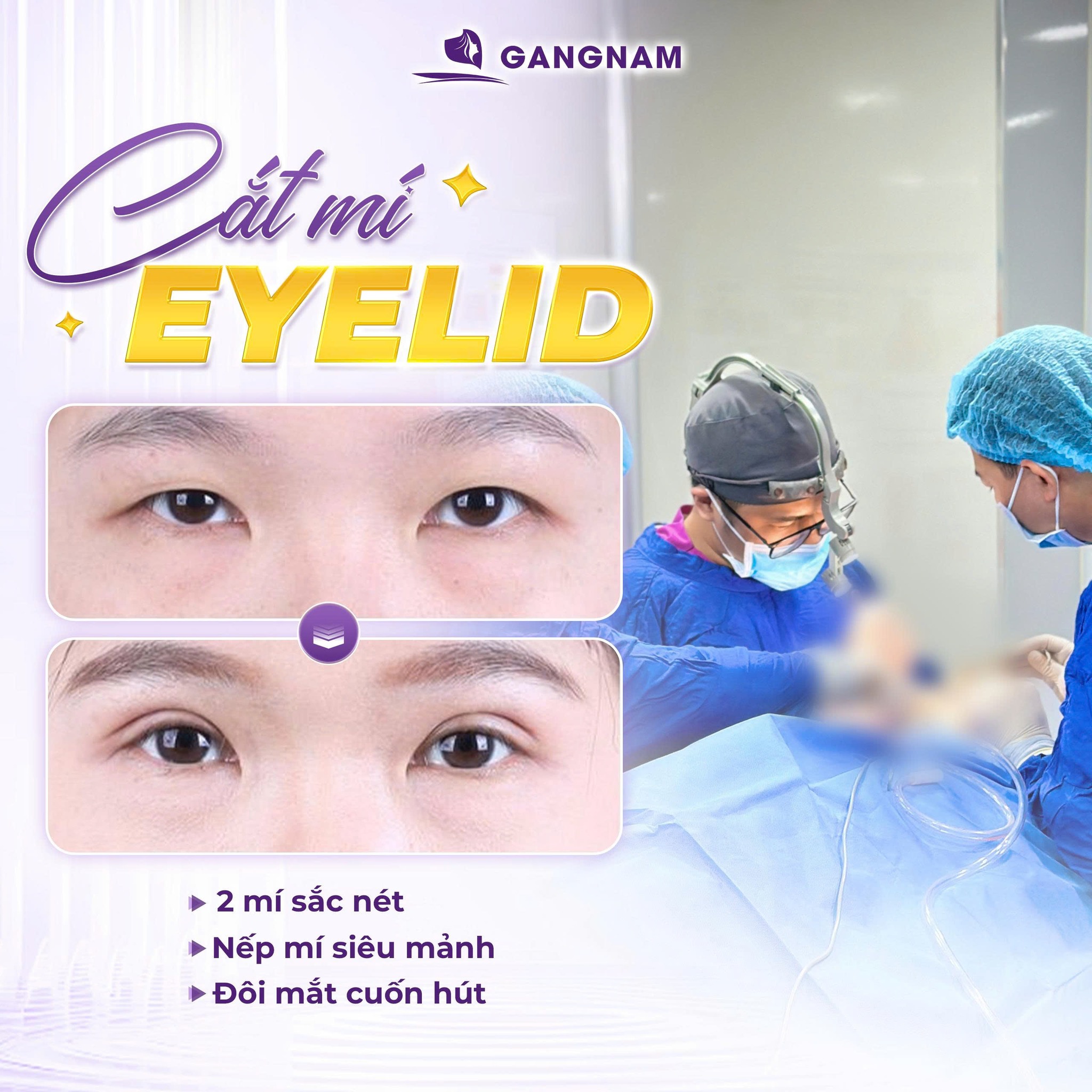 Cắt mí trên Eyelid – Giải pháp trẻ hóa đôi mắt tự nhiên và an toàn 6 Thẩm mỹ Gangnam – Địa chỉ cắt mí trên Eyelid công nghệ cao
