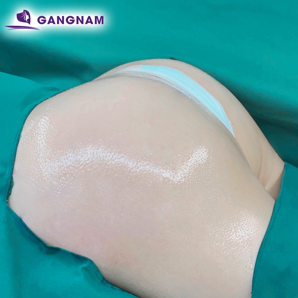 Nâng mông túi độn 4K: Giải pháp hiện đại cho vòng 3 hoàn hảo 4 Công nghệ nội soi 4K trong nâng mông túi độn 4K hoạt động như thế nào?