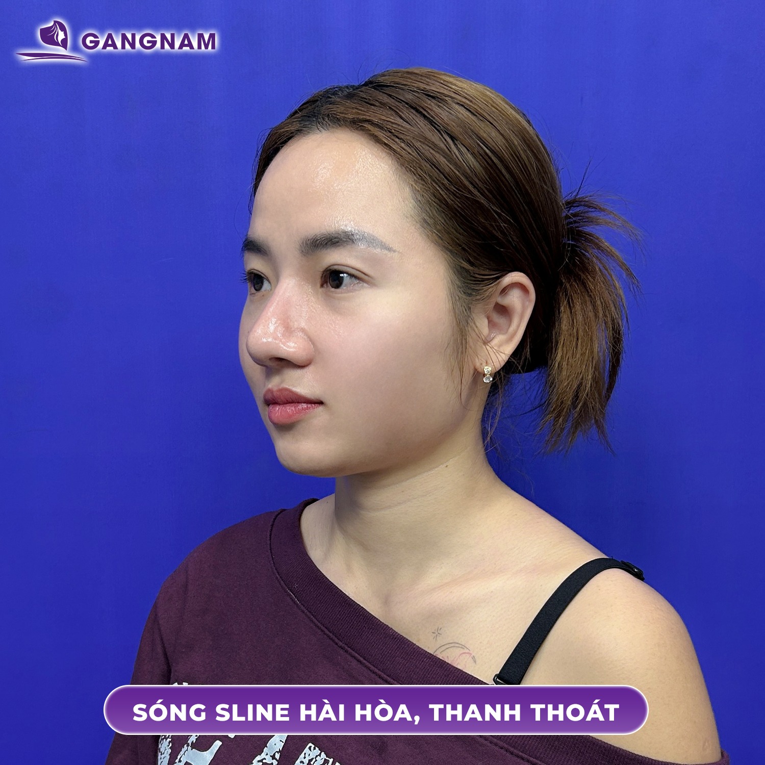 Tạo dáng mũi S-Line Mega Nose: Bí quyết sở hữu dáng mũi hoàn hảo 4 Tạo dáng mũi S-Line Mega Nose là gì?