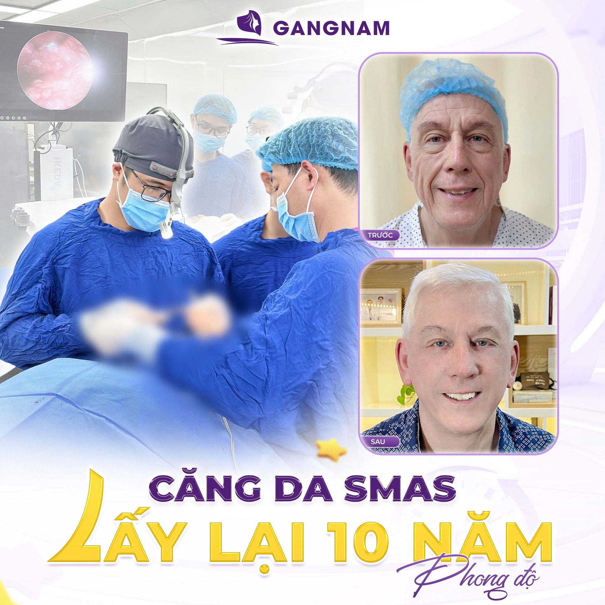 Căng Da Mặt SMAS Nội Soi: Giải Pháp Trẻ Hóa Toàn Diện, Hiệu Quả 4 Căng da mặt SMAS nội soi là gì? Tại sao lại quan trọng?