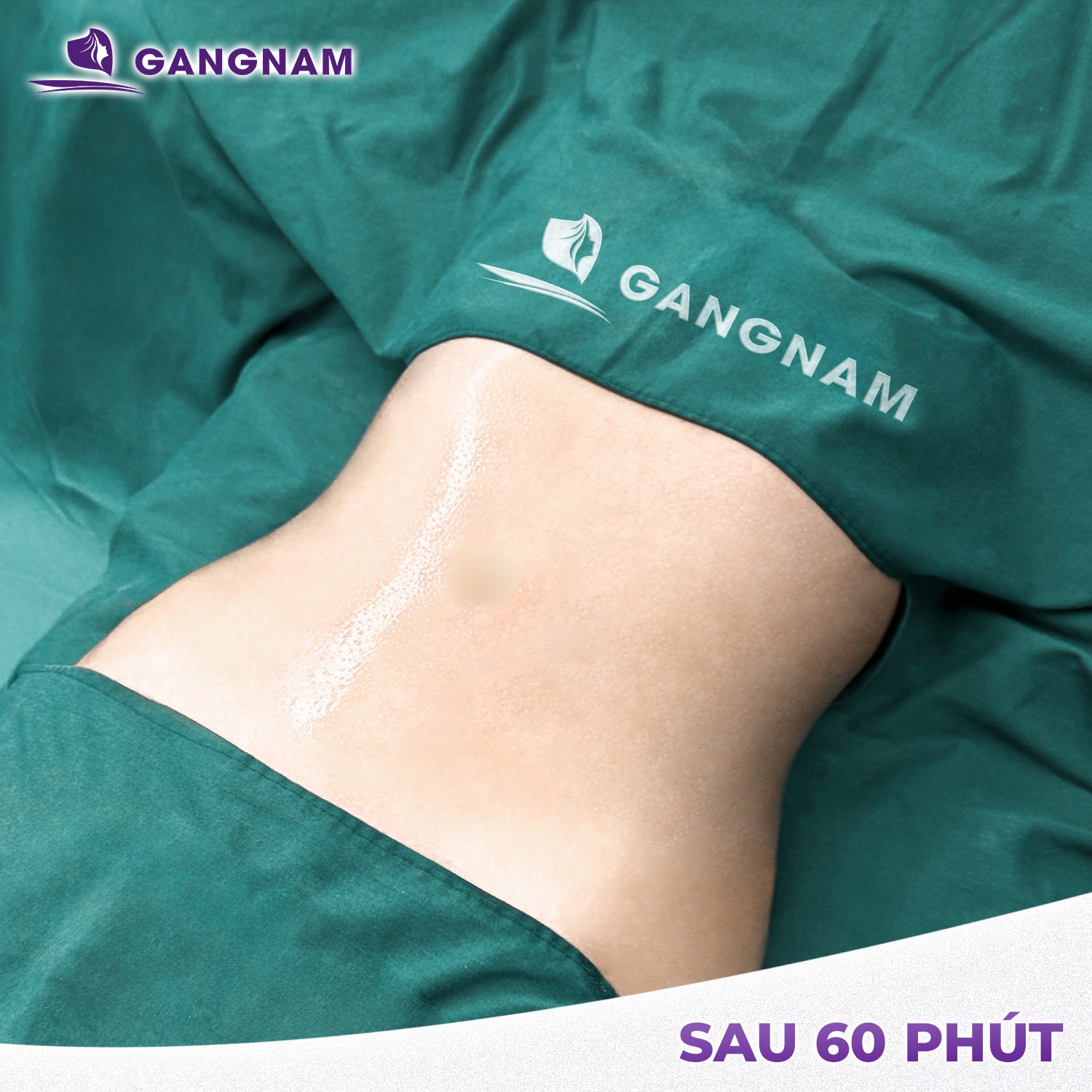 Hút mỡ bụng toàn phần: Giải pháp hiệu quả cho vòng eo thon gọn 4 Hút mỡ bụng toàn phần là gì?