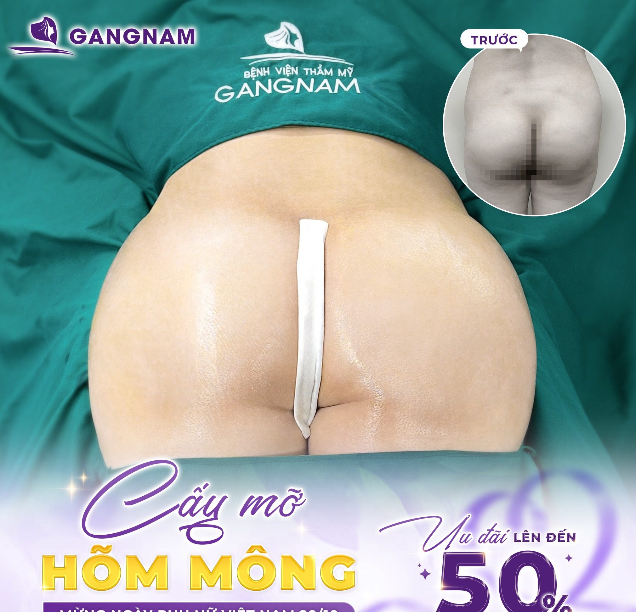 Cấy mỡ vòng 3: Bí quyết sở hữu vòng 3 căng tròn tự nhiên và quyến rũ 6 Nâng dáng mông với công nghệ cấy mỡ vòng 3 thẩm mỹ Gangnam