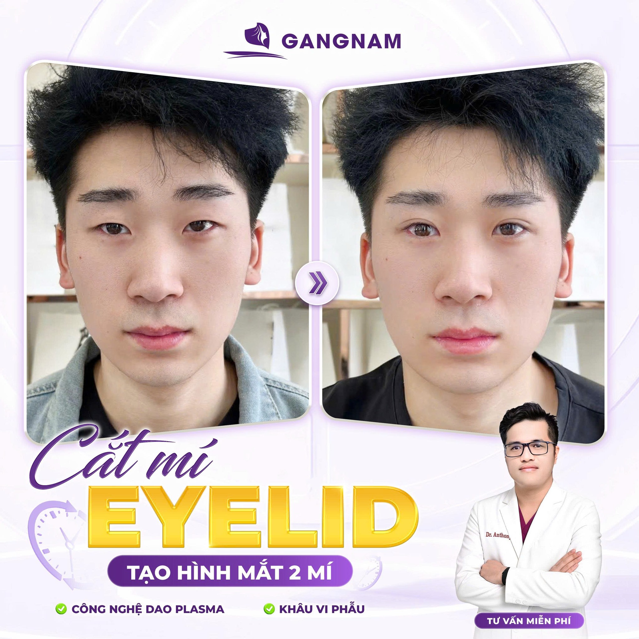 Cắt mí mắt nam: Bí quyết sở hữu ánh nhìn sắc nét và nam tính 5 Kỹ thuật cắt mí mắt nam tiên tiến nhất năm 2026