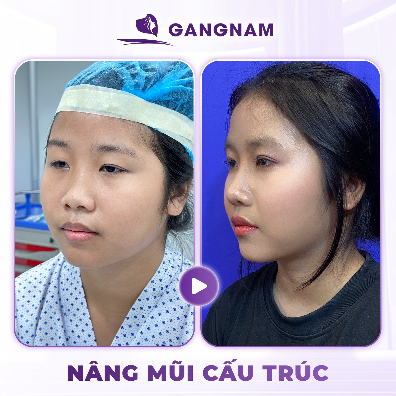 Nâng mũi cấu trúc chuẩn y khoa – Giải pháp tái tạo dáng mũi hoàn hảo 4 Nâng mũi cấu trúc chuẩn y khoa là gì?