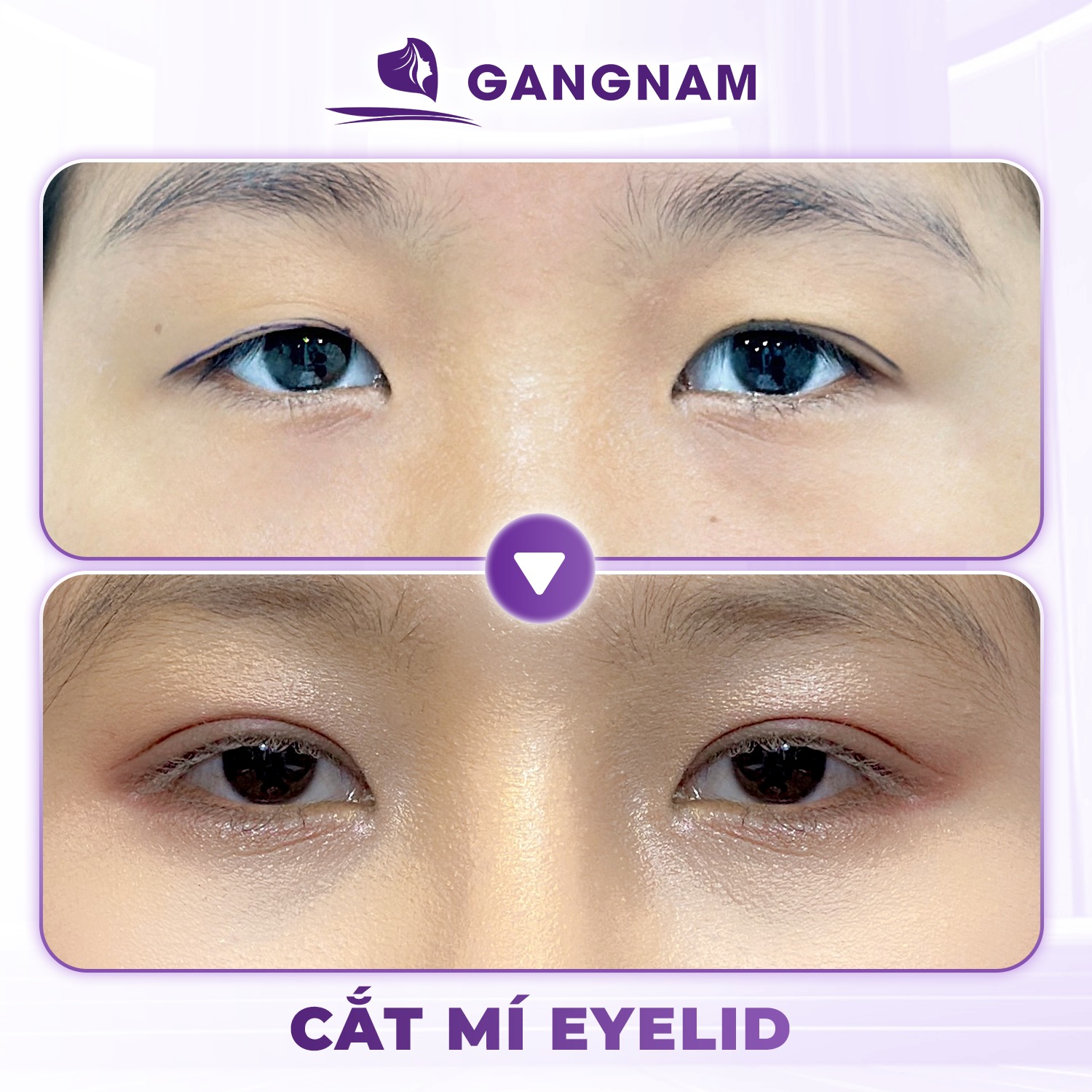 Cắt mí Eyelid Hàn Quốc: Bí quyết sở hữu đôi mắt hai mí tự nhiên 4 Cắt mí Eyelid Hàn Quốc là gì và tại sao đang hot năm 2026?