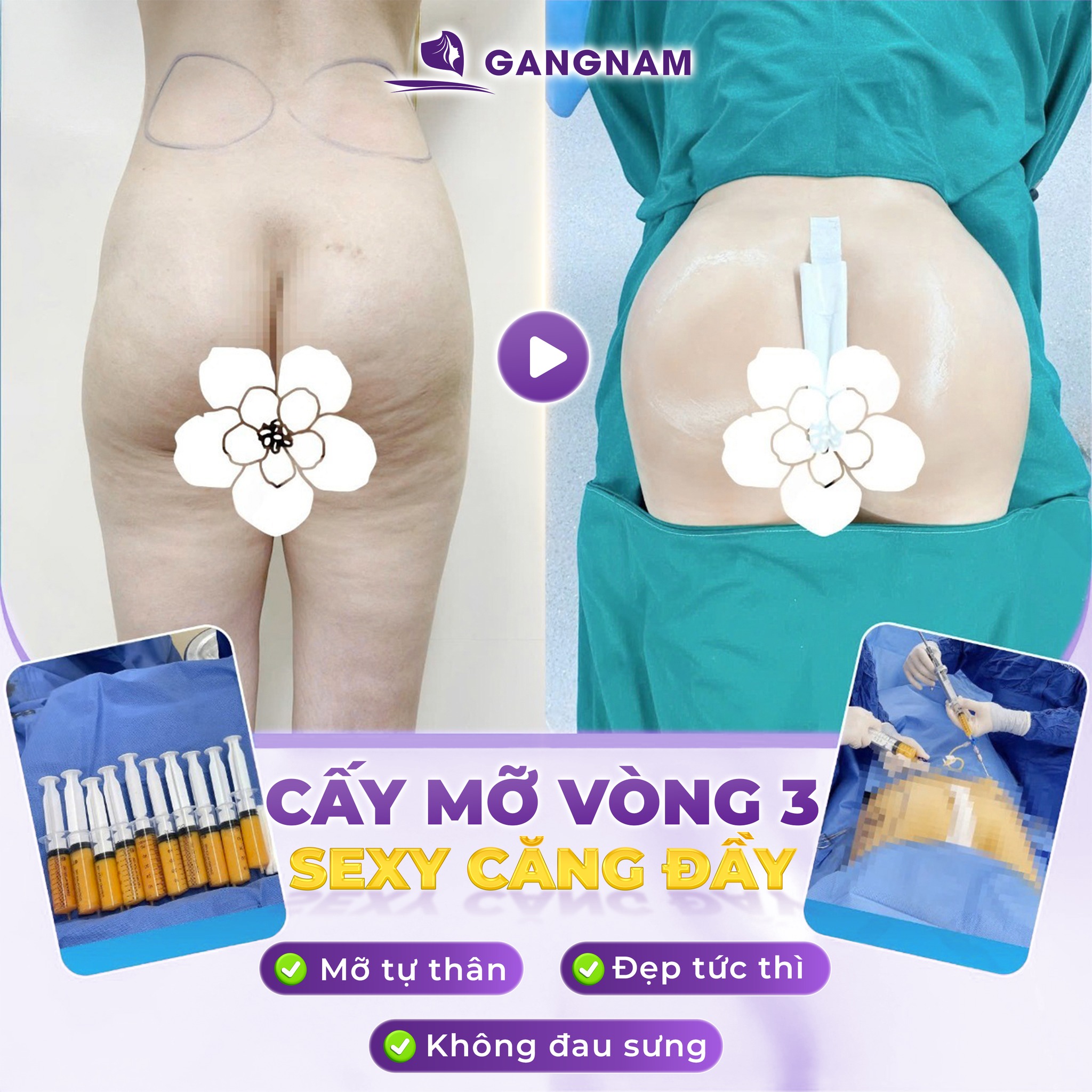 Cấy mỡ vòng 3: Bí quyết sở hữu vòng 3 căng tròn tự nhiên và quyến rũ 5 Cấy mỡ vòng 3: Bí quyết sở hữu vòng 3 căng tròn tự nhiên và quyến rũ 2