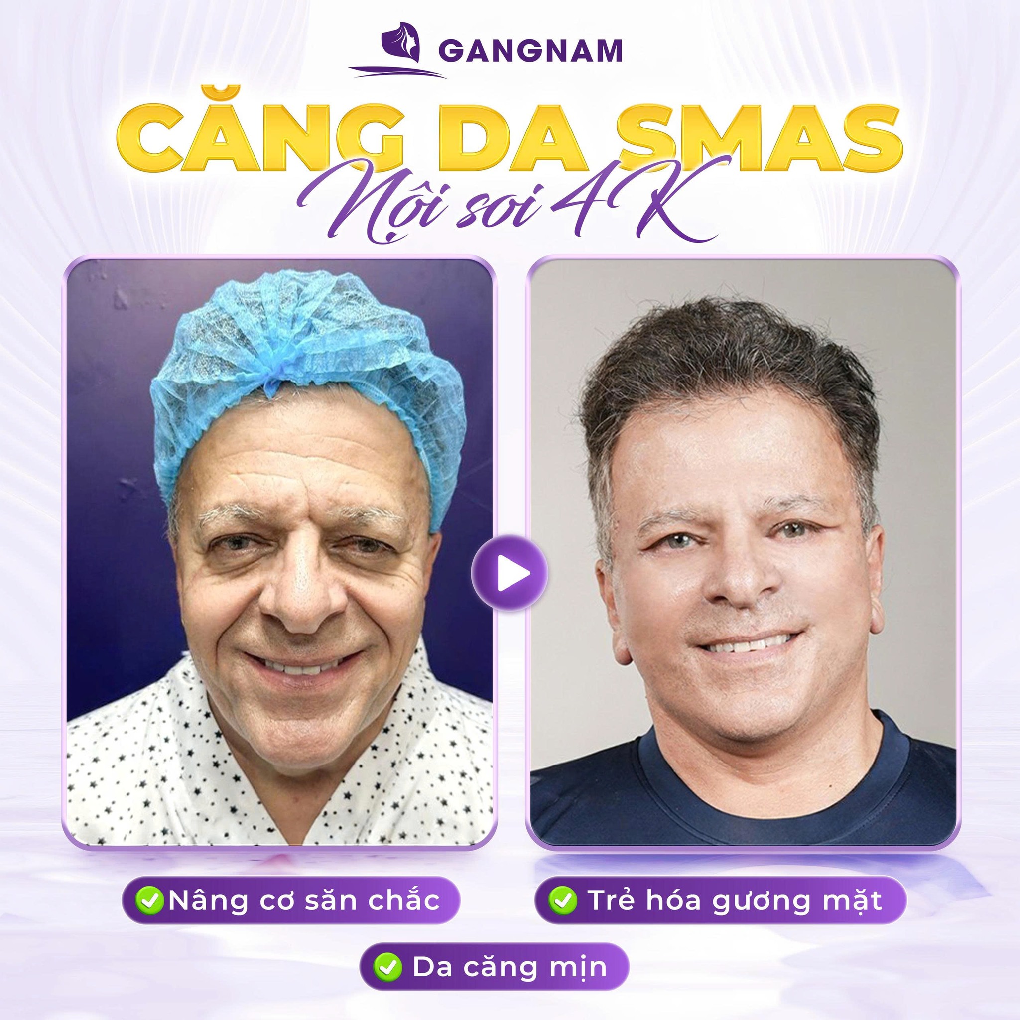 Căng da mặt SMAS toàn phần – Giải pháp trẻ hóa sâu, bền vững 5 Ai là ứng viên phù hợp nhất với căng da mặt SMAS toàn phần?