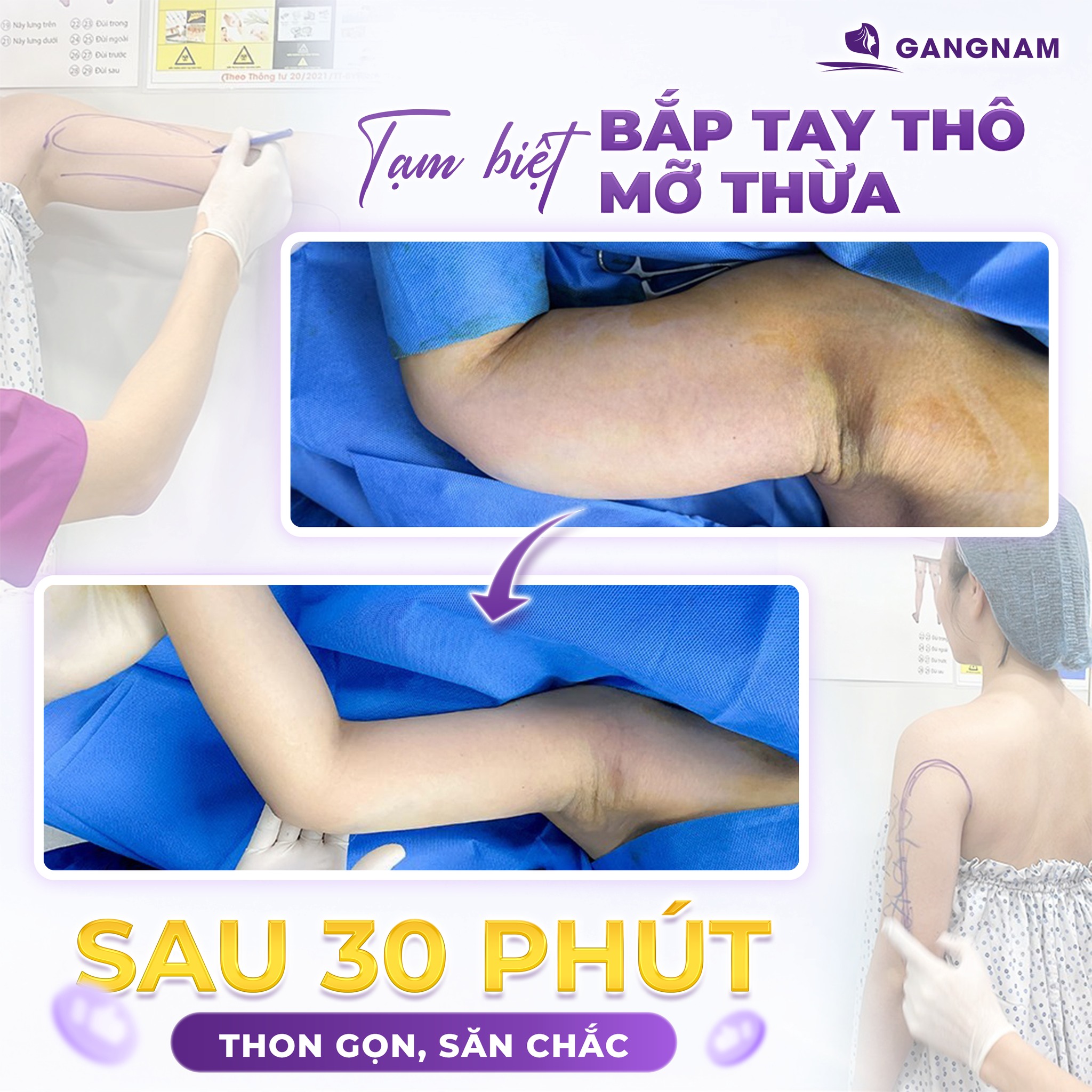 Hút mỡ cánh tay Lipo Ultrasound – Giải pháp thon gọn bắp tay an toàn 4 Cơ chế hoạt động của hút mỡ cánh tay Lipo Ultrasound