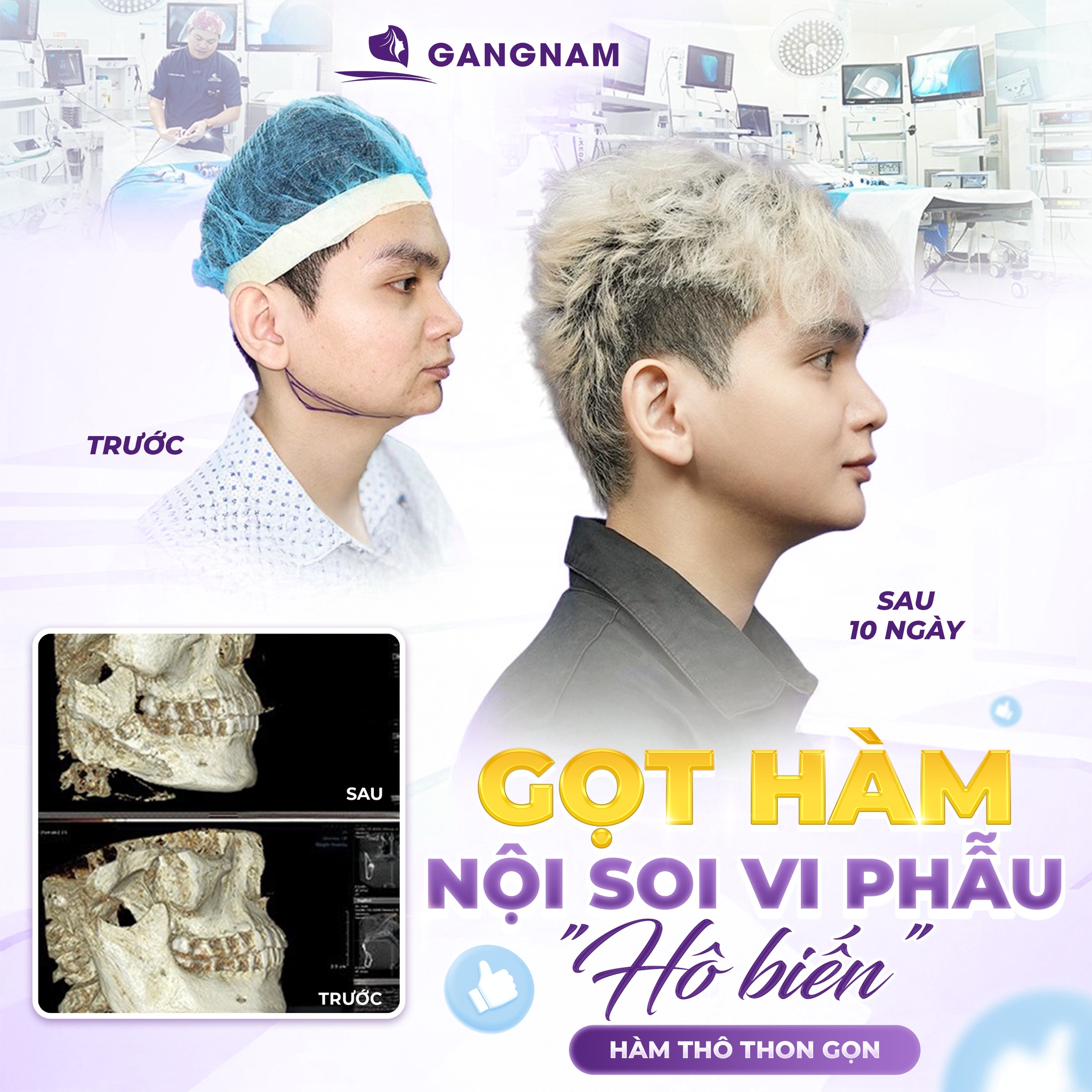 Gọt hàm nội soi: Phương pháp thẩm mỹ hiện đại cho khuôn mặt V-line 6 Gọt hàm nội soi tại Thẩm mỹ Gangnam – Giải pháp chuẩn Hàn cho gương mặt V-line