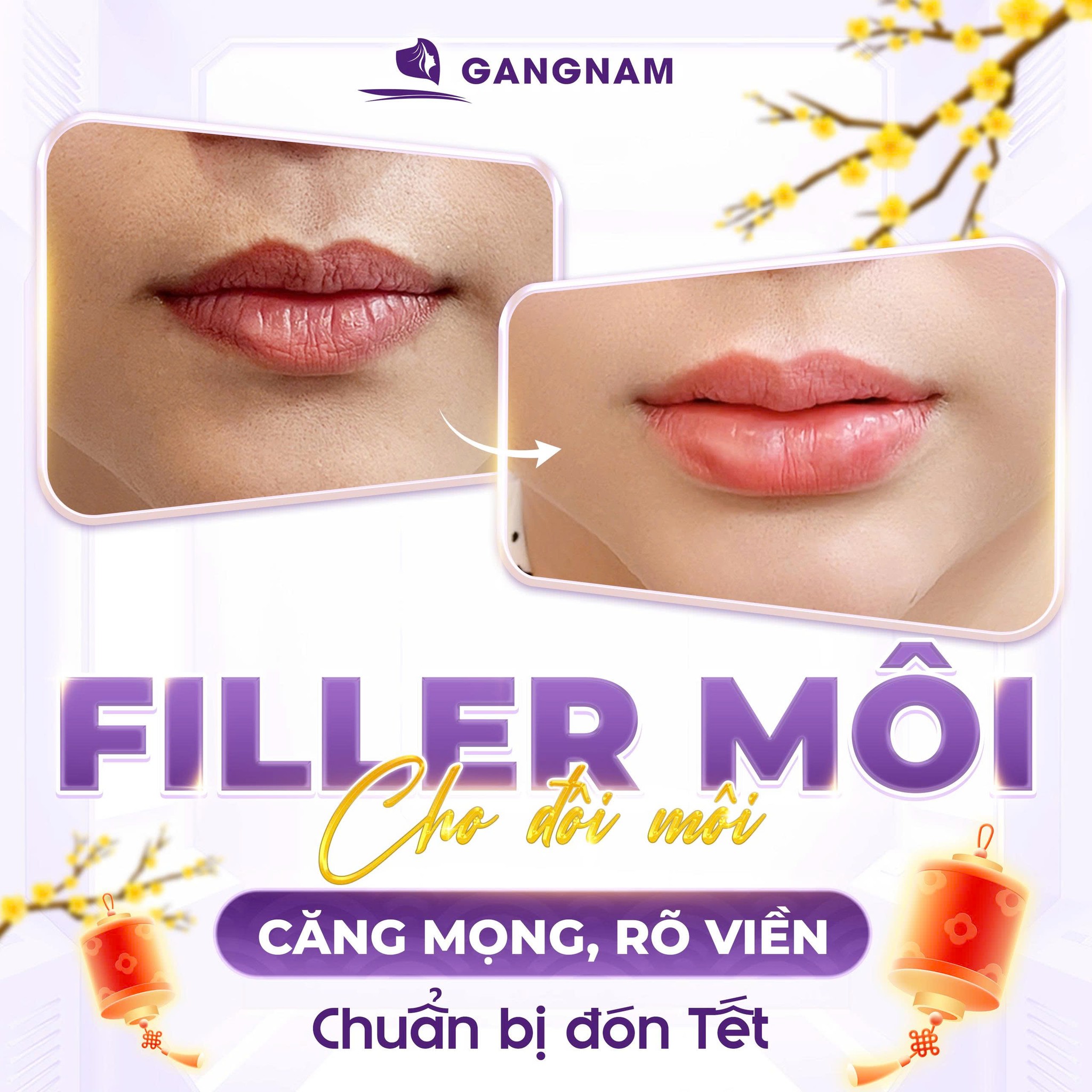 Tiêm filler môi baby: Bí quyết sở hữu đôi môi căng mọng tự nhiên và trẻ trung 6 Tiêm filler môi baby tại Thẩm mỹ Gangnam – lựa chọn cho vẻ đẹp tự nhiên