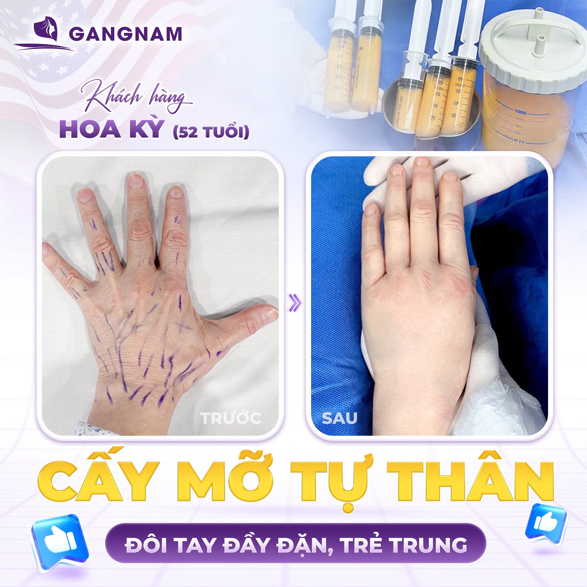 Cấy mỡ tự thân bàn tay: Giải pháp trẻ hóa đôi tay tự nhiên và bền vững 4 Tại sao nên chọn cấy mỡ tự thân bàn tay?