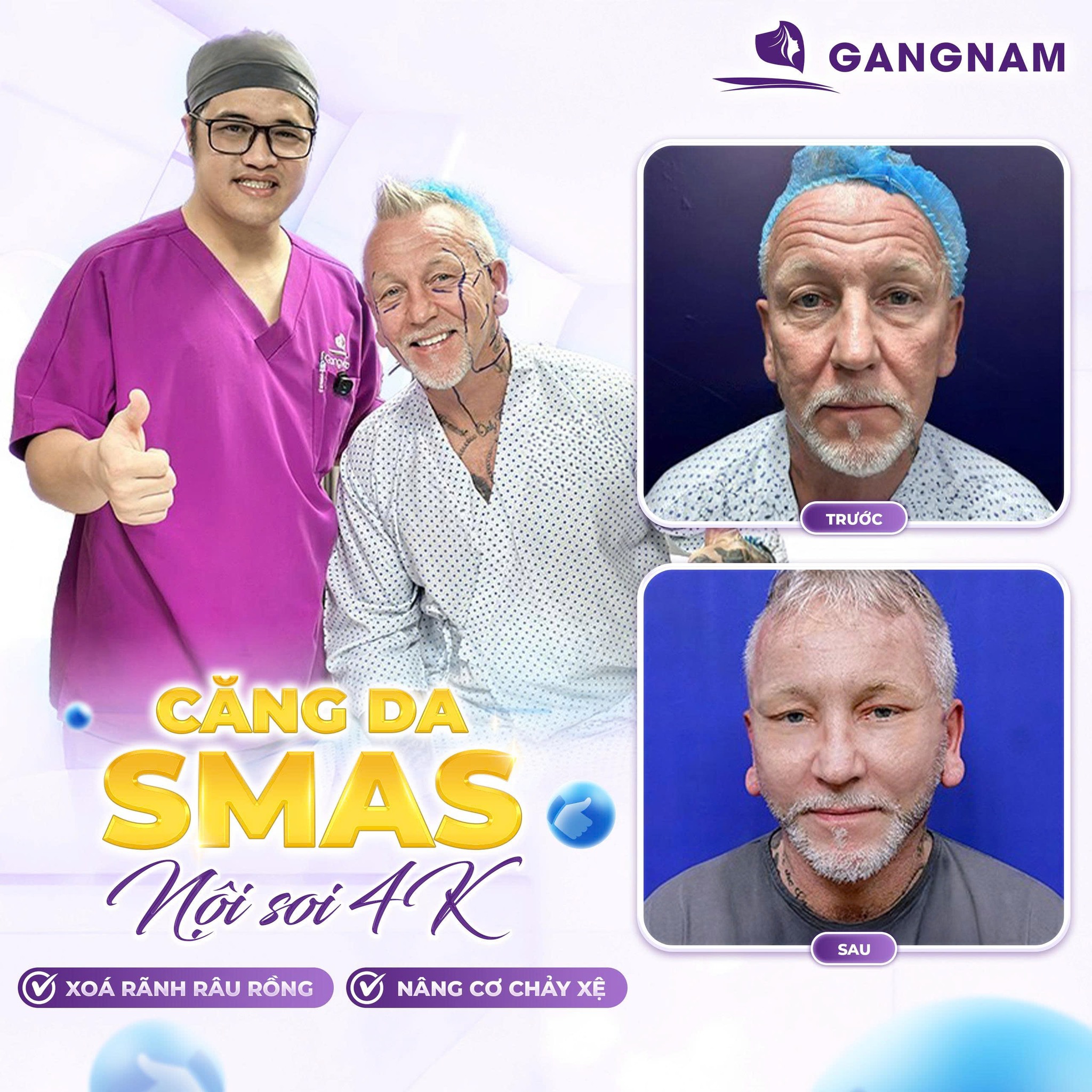 Căng da mặt nội soi SMAS: Giải pháp trẻ hóa toàn diện 6 Căng da mặt nội soi SMAS – Giải pháp trẻ hóa chuẩn Hàn tại Thẩm mỹ Gangnam