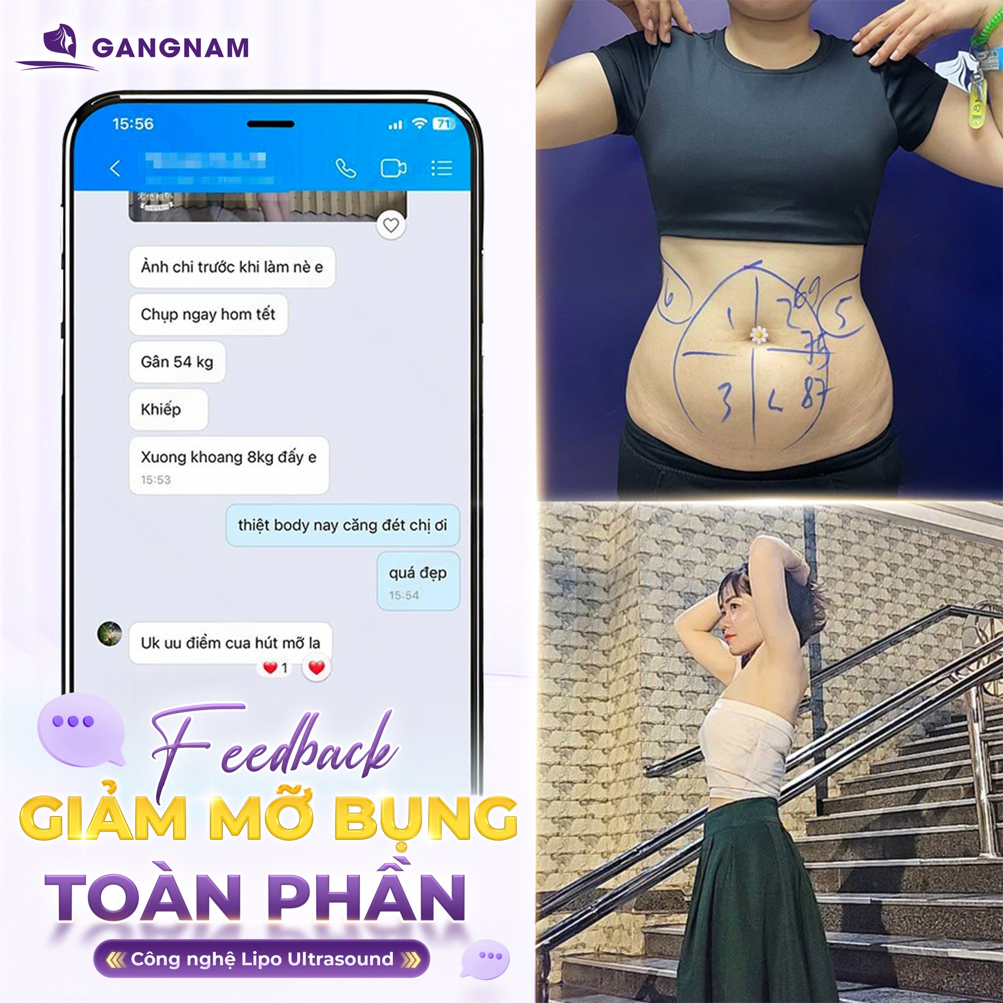 Hút mỡ bụng Lipo – Giải pháp lấy lại vòng eo thon gọn, săn chắc 5 Lợi ích vượt trội của hút mỡ bụng Lipo trong tạo hình vóc dáng hiện đại